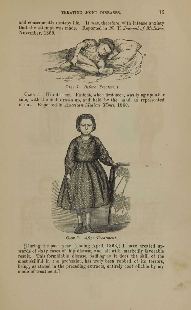 and consequently destroy life. It was, therefore, with intense anxiety that the attempt was made. Reported in iV. Y. Journal of Medicine, November, 1859. Case 7. Before Treatment. Case 1.—Hip disease. Patient, when first seen, was lying upon her side, with the limb drawn up, and held by the hand, as represented in cut. Reported in American Medical Times, 1860. After Treatment. [During the past year (ending April, 1863,) I have treated up- wards of sixty cases of hip disease, and all with markedly favorable result. This formidable disease, baffling as it does the skill of the most skillful in the profession, has truly been robbed of its terrors, being, as stated in the preceding extracts, entirely controllable by my mode of treatment.]