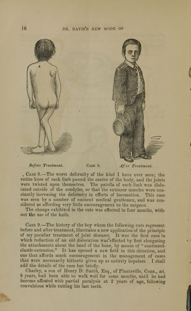 Before Treatment. Case 8. Afier Treatment. . Case 8.—The worst deformity of the kind I have ever seen; the entire knee of each limb passed the centre of the body, and the joints were twisted upon themselves. The patella of each limb was dislo- cated outside of the condyles, so that the extensor muscles were con- stantly increasing the deformity iu efforts of locomotion. This case was seen by a number of eminent medical gentlemen, and was con- sidered as affording very little encouragement to the surgeon. The change exhibited in the cuts was effected in four months, with- out the use of the knife. Case 9.—The history of the boy whom the following cuts represent before and after treatment, illustrates a new application of the principle of my peculiar treatment of joint diseases. It was the first case in which reduction of an old dislocation was'effected by first elongating the attachments about the head of the bone, by means of  continued- elastic-extension. It has opened a new field in this direction, and one that affords much encouragement in the management of cases that were necessarily hitherto given up as entirely hopeless. I shall add the details of the case but briefly. Charley, a son of Henry D. Smith, Esq., of Plantsville, Conn., set. 8 years, had been able to walk well for some mouths, until he had become affeoted with partial paralysis at 2 years of age, following convulsions while cutting his last teeth.