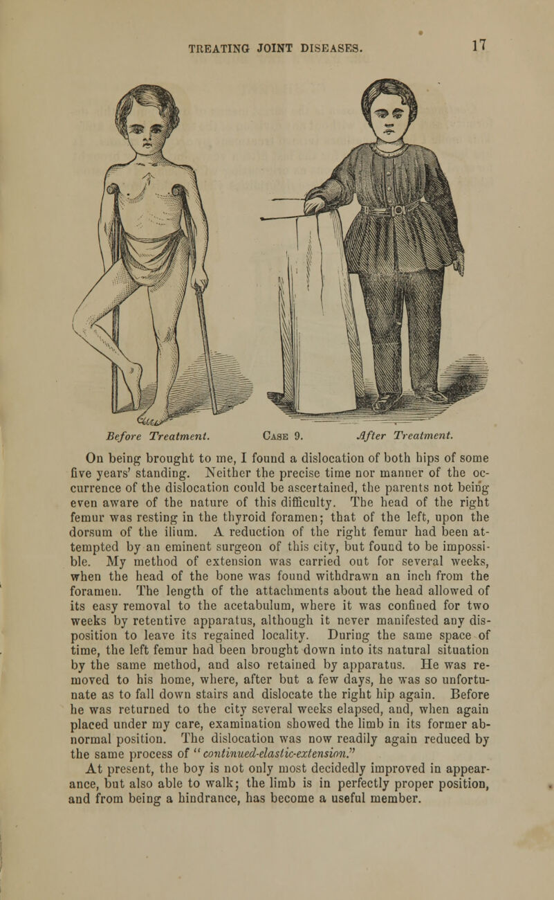 Before Treatment. Case 9. After Treatment. On being brought to me, I found a dislocation of both hips of some five years' standing. Neither the precise time nor manner of the oc- currence of the dislocation could be ascertained, the pai'ents not being- even aware of the nature of this difficulty. The head of the right femur was resting in the thyroid foramen; that of the left, upon the dorsum of the ilium. A. reduction of the right femur had been at- tempted by an eminent surgeon of this city, but found to be impossi- ble. My method of extension was carried out for several weeks, when the head of the bone was found withdrawn an inch from the foramen. The length of the attachments about the head allowed of its easy removal to the acetabulum, where it was confined for two weeks by retentive apparatus, although it never manifested any dis- position to leave its regained locality. During the same space of time, the left femur had been brought down into its natural situation by the same method, and also retained by apparatus. He was re- moved to his home, where, after but a few days, he was so unfortu- nate as to fall down stairs and dislocate the right hip again. Before he was returned to the city several weeks elapsed, and, when again placed under my care, examination showed the limb in its former ab- normal position. The dislocation was now readily again reduced by the same process of  continued-elastic-extension., At present, the boy is not only most decidedly improved in appear- ance, but also able to walk; the limb is in perfectly proper position, and from being a hindrance, has become a useful member.