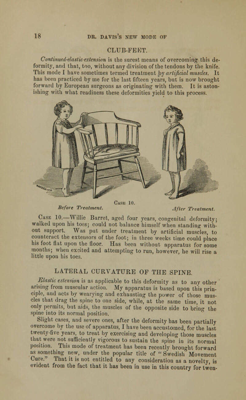 CLUB-FEKT. Continued-elastic extension is the surest means of overcoming this de- formity, and that, too, without any division of the tendons by the knife. This mode I have sometimes termed treatment by artificial muscles. It has been practiced by me for the last fifteen years, but is now brought forward by European surgeons as originating with them. It is aston- ishing with what readiness these deformities yield to this process. Before Treatment. Case 10. After Treatment. Case 10.—Willie Barret, aged four years, congenital deformity; walked upon his toes; could not balance himself when standing with- out support. Was put under treatment by artificial muscles, to counteract the extensors of the foot; in three weeks time could place his foot flat upon the floor. Has been without apparatus for some months; when excited and attempting to run, however, he will rise a little upon his toes. LATERAL CURVATURE OP THE SPINE. Elastic extension is as applicable to this deformity as to any other arising from muscular action. My apparatus is based upon this prin- ciple, and acts by wearying and exhausting the power of those mus- cles that drag the spine to one side, while, at the same time, it not only permits, but aids, the muscles of the opposite side to brln<>- the spine into its normal position. Slight cases, and severe ones, after the deformity has been partially overcome by the use of apparatus, I have been accustomed, for the last twenty-five years, to treat by exercising and developing those muscles that were not#sufficiently vigorous to sustain the spine in its normal position. This mode of treatment has been recently brought forward as something new, under the popular title of  Swedish Movement Cure. That it is not entitled to any consideration as a novelty, is evident from the fact that it has been in use in this country for twen-