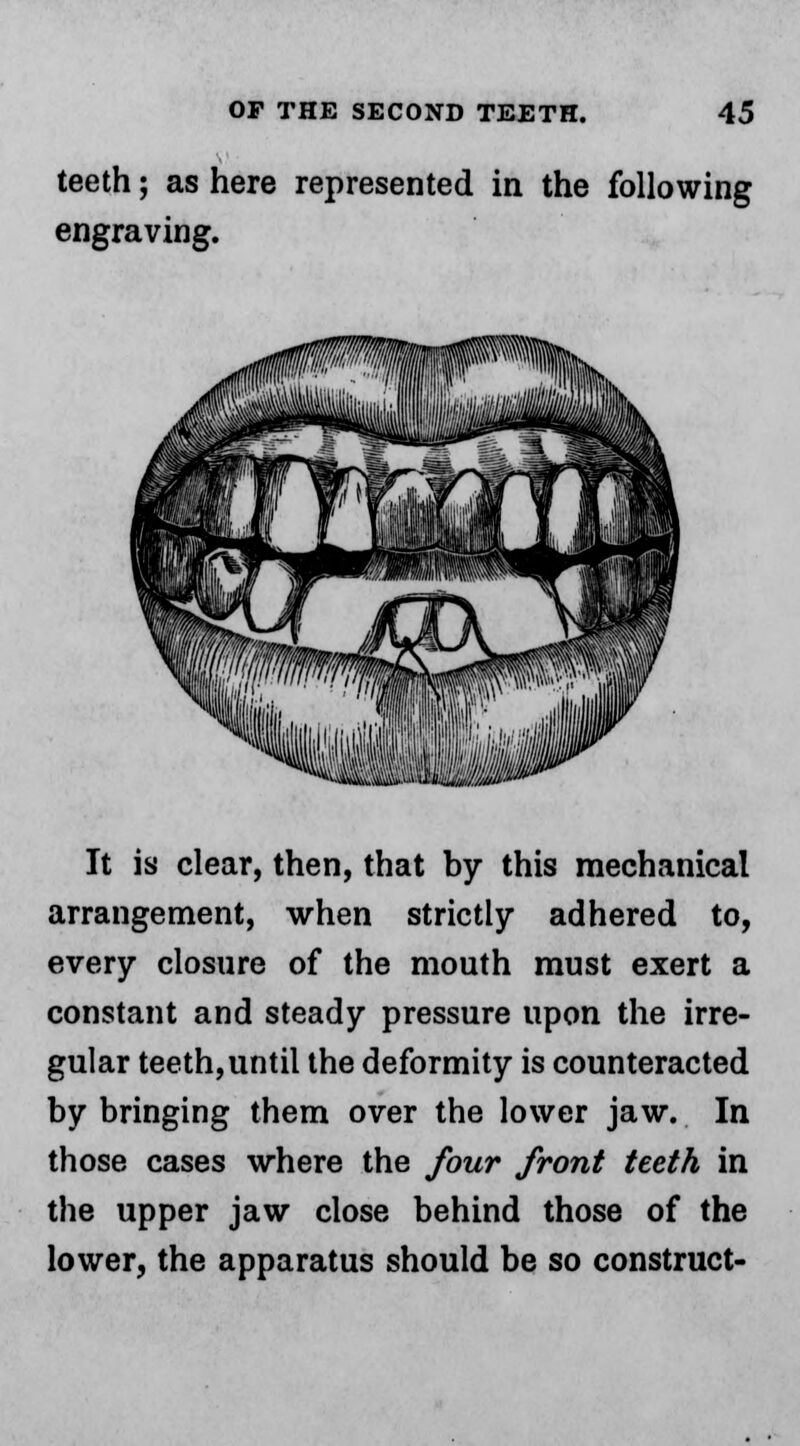 teeth; as here represented in the following engraving. It is clear, then, that by this mechanical arrangement, when strictly adhered to, every closure of the mouth must exert a constant and steady pressure upon the irre- gular teeth,until the deformity is counteracted by bringing them over the lower jaw. In those cases where the four front teeth in the upper jaw close behind those of the lower, the apparatus should be so construct-