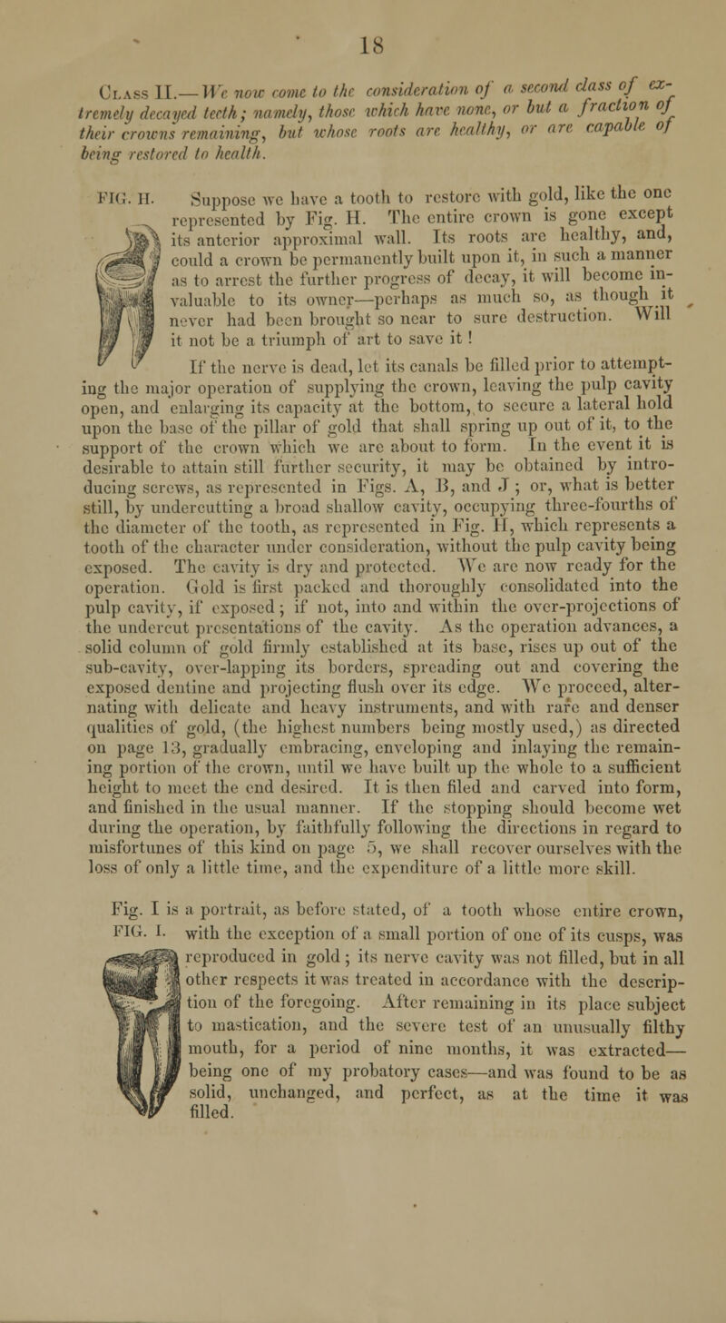 Class II.—We now come to the consideration of a second class of ex- trcmchi decayed teeth; namely, those which hare, none, or but a fraction oj their crowns remaining, but whose roots arc healthy, or are capable of being restored to health. PIG. II. Suppose we have a tooth to restore with gold, like the one represented by Fig. II. The entire crown is gone except its anterior approximal wall. Its roots are healthy, and, could a crown be permanently built upon it, in such a manner as to arrest the further progress of decay, it will become in- valuable to its owner—perhaps as much so, as though it never had been brought so near to sure destruction. Will it not be a triumph of art to save it ! If the nerve is dead, let its canals be filled prior to attempt- ing the major operation of supplying the crown, leaving the pulp cavity open, and enlarging its capacity at the bottom, to secure a lateral hold upon the base of the pillar of gold that shall spring up out of it, to the support of the crown which we are about to form. In the event it is desirable to attain still further security, it may be obtained by intro- ducing screws, as represented in Figs. A, B, and J ; or, what is better still, by undercutting a broad shallow cavity, occupying three-fourths of the diameter of the tooth, as represented in Fig. II, which represents a tooth of the character under consideration, without the pulp cavity being exposed. The cavity is dry and protectee!. We are now ready for the operation. Gold is first packed and thoroughly consolidated into the pulp cavity, if exposed; if not, into and within the over-projections of the undercut presentations of the cavity. As the operation advances, a solid column of gold firmly established at its base, rises up out of the sub-cavity, over-lapping its borders, spreading out and covering the exposed dentine and projecting flush over its edge. We proceed, alter- nating with delicate and heavy instruments, and with rare and denser qualities of gold, (the highest numbers being mostly used,) as directed on page 13, gradually embracing, enveloping and inlaying the remain- ing portion of the crown, until we have built up the whole to a sufficient height to meet the end desired. It is then filed and carved into form, and finished in the usual manner. If the stopping should become wet during the operation, by faithfully following the directions in regard to misfortunes of this kind on page 5, we shall recover ourselves with the loss of only a little time, and the expenditure of a little more skill. Fig. I is FIG. I. a portrait, as before stated, of a tooth whose entire crown, with the exception of a small portion of one of its cusps, was reproduced in gold ; its nerve cavity was not filled, but in all other respects it was treated in accordance with the descrip- tion of the foregoing. After remaining in its place subject to mastication, and the severe test of an unusually filthy mouth, for a period of nine months, it was extracted— being one of my probatory cases—and was found to be as solid, unchanged, and perfect, as at the time it was filled.