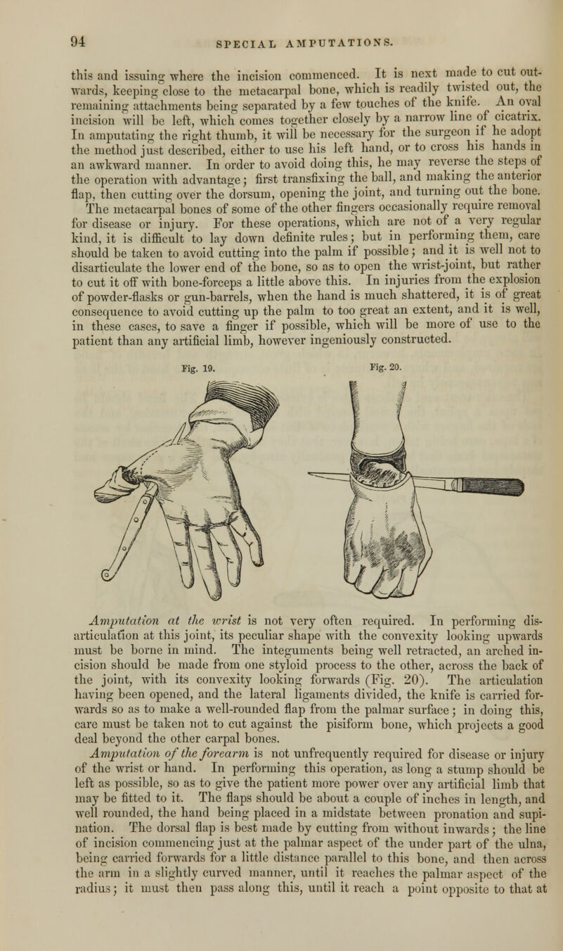 this and issuing where the incision commenced. It is next made to cut out- wards, keeping close to the metacarpal bone, which is readily twisted out, the remaining attachments being separated by a few touches of the knife. An oval incision will be left, which comes together closely by a narrow line of cicatrix. In amputating the right thumb, it will be necessary for the surgeon if he adopt the method just described, either to use his left hand, or to cross his hands in an awkward manner. In order to avoid doing this, he may reverse the stepsof the operation with advantage; first transfixing the ball, and making the anterior flap, then cutting over the dorsum, opening the joint, and turning out the bone. The metacarpal bones of some of the other fingers occasionally require removal for disease or injury. For these operations, which are not of a very regular kind, it is difficult to lay down definite rules; but in performing them, care should be taken to avoid cutting into the palm if possible; and it is well not to disarticulate the lower end of the bone, so as to open the wrist-joint, but rather to cut it off with bone-forceps a little above this. In injuries from the explosion of powder-flasks or gun-barrels, when the hand is much shattered, it is of great consequence to avoid cutting up the palm to too great an extent, and it is well, in these cases, to save a finger if possible, which will be more of use to the patient than any artificial limb, however ingeniously constructed. Fig. 19. Fig. 20. Amputation at the wrist is not very often required. In performing dis- articulation at this joint, its peculiar shape with the convexity looking upwards must be borne in mind. The integuments being well retracted, an arched in- cision should be made from one styloid process to the other, across the back of the joint, with its convexity looking forwards (Fig. 20). The articulation having been opened, and the lateral ligaments divided, the knife is carried for- wards so as to make a well-rounded flap from the palmar surface; in doing this, care must be taken not to cut against the pisiform bone, which projects a good deal beyond the other carpal bones. Amputation of the forearm is not unfrequently required for disease or injury of the wrist or hand. In performing this operation, as long a stump should be left as possible, so as to give the patient more power over any artificial limb that may be fitted to it. The flaps should be about a couple of inches in length, and well rounded, the hand being placed in a midstate between pronation and supi- nation. The dorsal flap is best made by cutting from without inwards; the line of incision commencing just at the palmar aspect of the under part of the ulna, being carried forwards for a little distance parallel to this bone, and then across the arm in a slightly curved manner, until it reaches the palmar aspect of the radius; it must then pass along this, until it reach a point opposite to that at