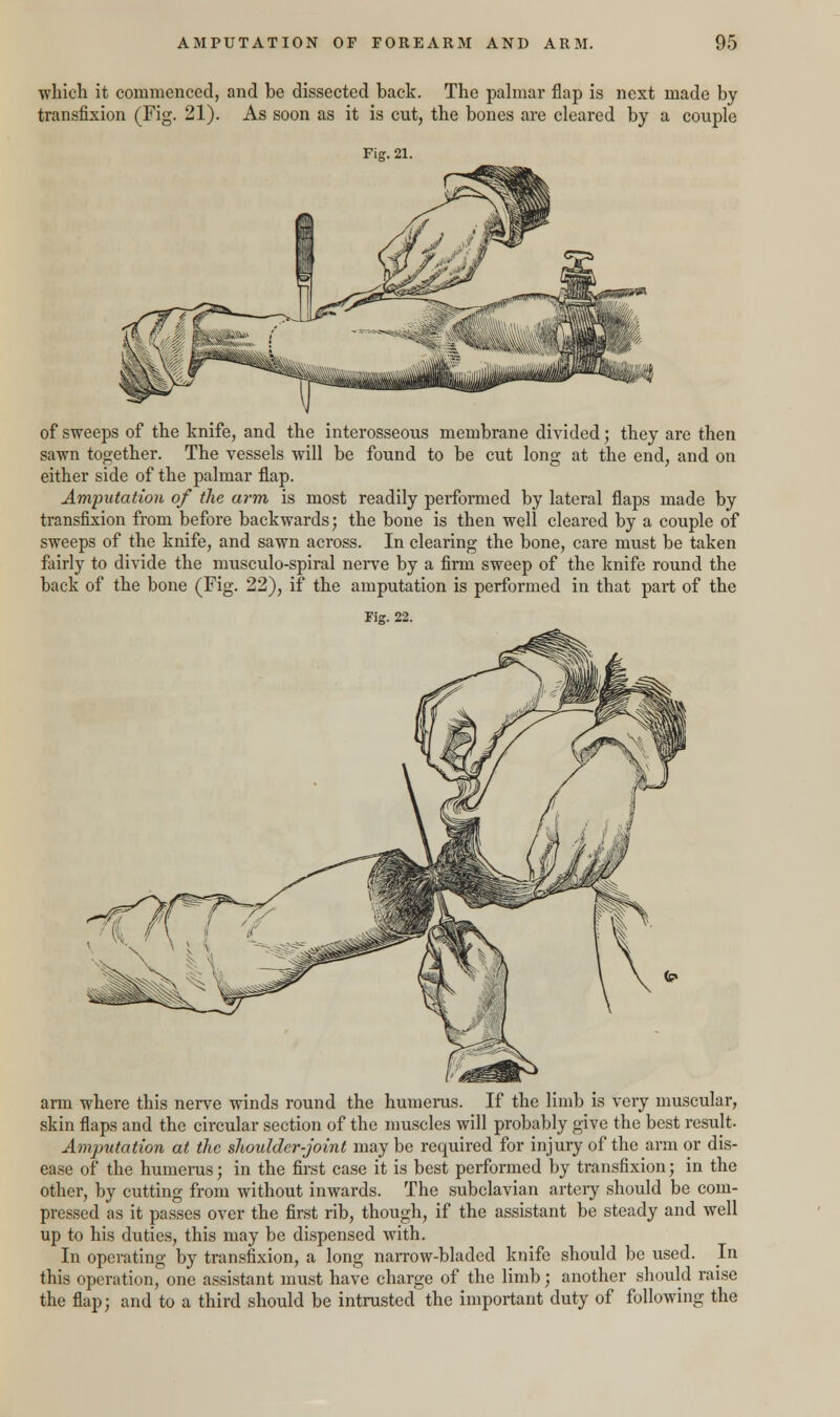 which it commenced, and be dissected back. The palmar flap is next made by transfixion (Fig. 21). As soon as it is cut, the bones are cleared by a couple Fig. 21. of sweeps of the knife, and the interosseous membrane divided; they are then sawn together. The vessels will be found to be cut long at the end, and on either side of the palmar flap. Amputation of the arm is most readily performed by lateral flaps made by transfixion from before backwards; the bone is then well cleared by a couple of sweeps of the knife, and sawn across. In clearing the bone, care must be taken fairly to divide the musculo-spiral nerve by a firm sweep of the knife round the back of the bone (Fig. 22), if the amputation is performed in that part of the Fig. 22. arm where this nerve winds round the humerus. If the limb is very muscular, skin flaps and the circular section of the muscles will probably give the best result. Amputation at the shoulder-joint may be required for injury of the arm or dis- ease of the humerus; in the first case it is best performed by transfixion; in the other, by cutting from without inwards. The subclavian artery should be com- pressed as it passes over the first rib, though, if the assistant be steady and well up to his duties, this may be dispensed with. In operating by transfixion, a long narrow-bladed knife should be used. In this operation, one assistant must have charge of the limb; another should raise the flap; and to a third should be intrusted the important duty of following the