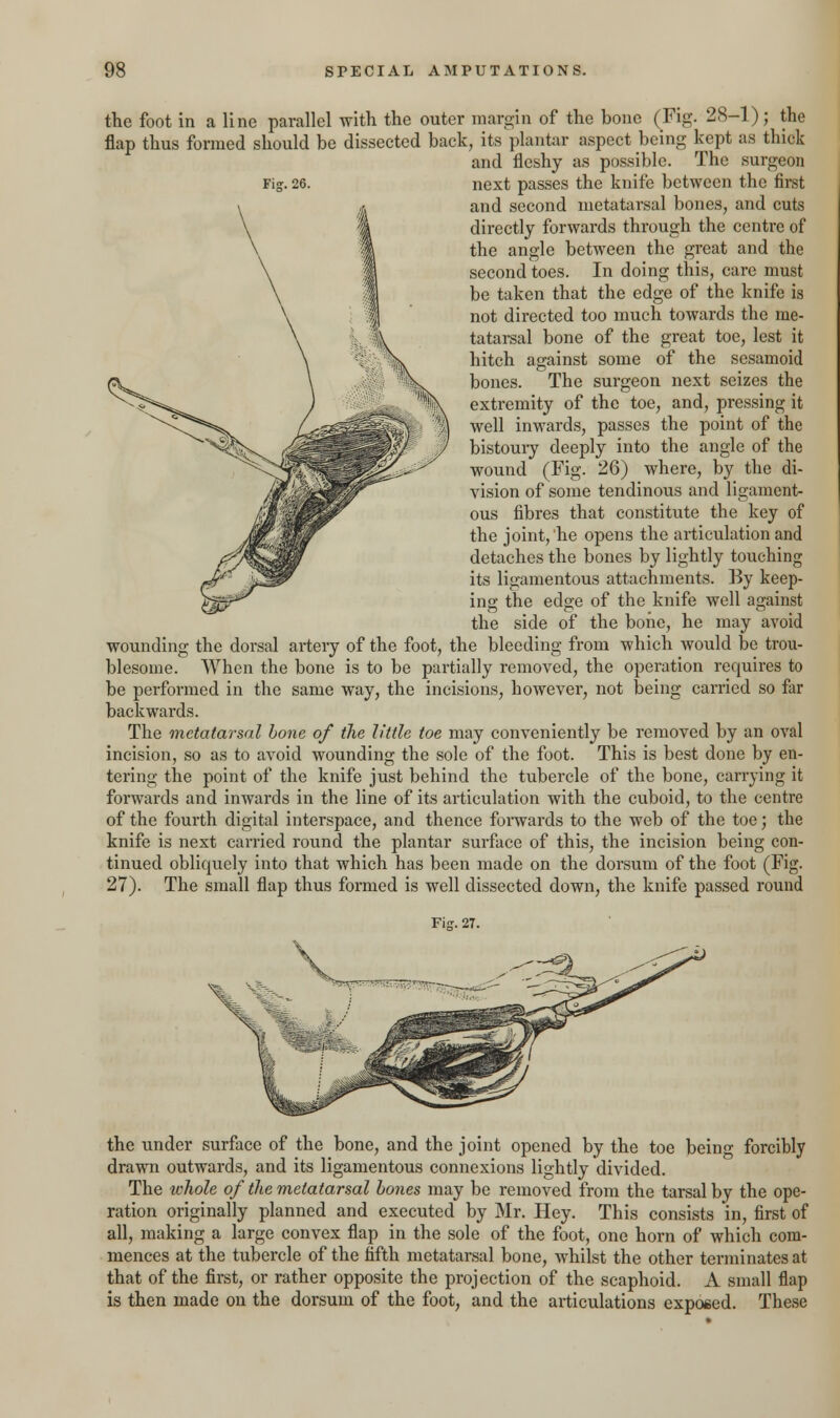 the foot in a line parallel with the outer margin of the bone (Fig. 28-1); the flap thus formed should be dissected back, its plantar aspect being kept as thick and fleshy as possible. The surgeon Fig. 26. next passes the knife between the first and second metatarsal bones, and cuts directly forwards through the centre of the angle between the great and the second toes. In doing this, care must be taken that the edge of the knife is not directed too much towards the me- tatarsal bone of the great toe, lest it hitch against some of the sesamoid bones. The surgeon next seizes the extremity of the toe, and, pressing it well inwards, passes the point of the bistoury deeply into the angle of the wound (Fig. 26) where, by the di- vision of some tendinous and ligament- ous fibres that constitute the key of the joint, he opens the articulation and detaches the bones by lightly touching its ligamentous attachments. By keep- ing the edge of the knife well against the side of the bone, he may avoid wounding the dorsal artery of the foot, the bleeding from which would be trou- blesome. When the bone is to be partially removed, the operation requires to be performed in the same way, the incisions, however, not being carried so far backwards. The metatarsal bone of the little toe may conveniently be removed by an oval incision, so as to avoid wounding the sole of the foot. This is best done by en- tering the point of the knife just behind the tubercle of the bone, carrying it forwards and inwards in the line of its articulation with the cuboid, to the centre of the fourth digital interspace, and thence forwards to the web of the toe; the knife is next carried round the plantar surface of this, the incision being con- tinued obliquely into that which has been made on the dorsum of the foot (Fig. 27). The small flap thus formed is well dissected down, the knife passed round Fig. 27. the under surface of the bone, and the joint opened by the toe being forcibly drawn outwards, and its ligamentous connexions lightly divided. The whole of the metatarsal bones may be removed from the tarsal by the ope- ration originally planned and executed by Mr. Hey. This consists in, first of all, making a large convex flap in the sole of the foot, one horn of which com- mences at the tubercle of the fifth metatarsal bone, whilst the other terminates at that of the first, or rather opposite the projection of the scaphoid. A small flap is then made on the dorsum of the foot, and the articulations exposed. These
