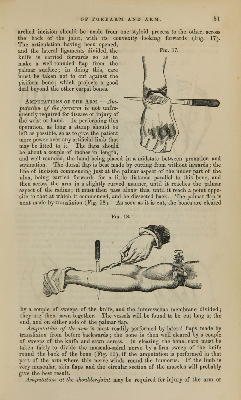 arched incision should be made from one styloid process to the other, across the back of the joint, with its convexity looking forwards (Fig. 17). The articulation having been opened, and the lateral ligaments divided, the Fig. 17. knife is carried forwards so as to make a well-rounded flap from the palmar surface; in doing this, care must be taken not to cut against the pisiform bone; which projects a good deal beyond the other carpal bones. Amputations of the Arm.—Am- putation of the forearm is not unfre- quently required for disease or injury of the wrist or hand. In performing this operation, as long a stump should be left as possible, so as to give the patient more power over any artificial limb that may be fitted to it. The flaps should be about a couple of inches in length, and well rounded, the hand being placed in a midstate between pronation and supination. The dorsal flap is best made by cutting from without inwards; the line of incision commencing just at the palmar aspect of the under part of the ulna, being carried forwards for a little distance parallel to this bone, and then across the arm in a slightly curved manner, until it reaches the palmar aspect of the radius; it must then pass along this, until it reach a point oppo- site to that at which it commenced, and be dissected back. The palmar flap is next made by transfixion (Fig. 18). As soon as it is cut, the bones are cleared Fia. 18. by a couple of sweeps of the knife, and the interosseous membrane divided; they are then sawn together. The vessels will be found to be cut long at the end, and on either side of the palmar flap. Amputation of the arm is most readily performed by lateral flaps made by transfixion from before backwards; the bone is then well cleared by a couple of sweeps of the knife and sawn across. In clearing the bone, care must be taken fairly to divide the musculo-spiral nerve by a firm sweep of the knife round the back of the bone (Fig. 19), if the amputation is performed in that part of the arm where this nerve winds round the humerus. If the limb is very muscular, skin flaps and the circular section of the muscles will probably give the best result. Amputation at the shoulder-joint may be required for injury of the arm or