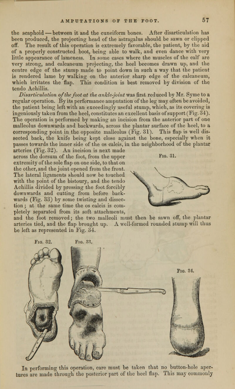 the scaphoid — between it and the cuneiform bones. After disarticulation has been produced, the projecting head of the astragalus should be sawn or clipped off. The result of this operation is extremely favorable, the patient, by the aid of a properly constructed boot, being able to walk, and even dance with very little appearance of lameness. In some cases where the muscles of the calf are very strong, and calcaneum projecting, the heel becomes drawn up, and the centre edge of the stump made to point down in such a way that the patient is rendered lame by walking on the anterior sharp edge of the calcaneum, which irritates the flap. This condition is best removed by division of the tendo Achillis. Disarticulation of the foot at the ankle-joint was first reduced by Mr. Syme to a regular operation. By its performance amputation of the leg may often be avoided, the patient being left with an exceedingly useful stump, which, as its covering is ingeniously taken from the heel, constitutes an excellent basis of support (Fig. 34). The operation is performed by making an incision from the anterior part of one malleolus downwards and backwards, across the plantar surface of the heel, to a corresponding point in the opposite malleolus (Fig. 31). This flap is well dis- sected back, the knife being kept close against the bone, especially when it passes towards the inner side of the os calcis, in the neighborhood of the plantar arteries (Fig. 32). An incision is next made across the dorsum of the foot, from the upper extremity of the sole flap on one side, to that on the other, and the joint opened from the front. The lateral ligaments should now be touched with the point of the bistoury, and the tendo Achillis divided by pressing the foot forcibly downwards and cutting from before back- wards (Fig. 33) by some twisting and dissec- tion ; at the same time the os calcis is com- pletely separated from its soft attachments, and the foot removed; the two malleoli must then be sawn off, the plantar arteries tied, and the flap brought up. A well-formed rounded stump will thus be left as represented in Fig. 34. Fig. 31. Fig. 32. Fig. 33. Fig. 34. In performing this operation, care must be taken that no button-hole aper- tures are made through the posterior part of the heel flap. This may commonly