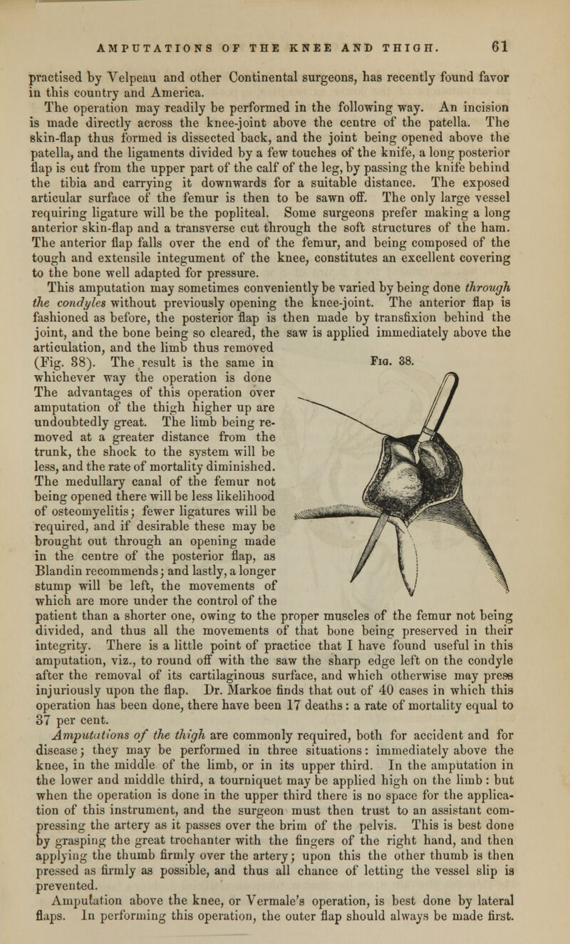 practised by Velpeau and other Continental surgeons, has recently found favor in this country and America. The operation may readily be performed in the following way. An incision is made directly across the knee-joint above the centre of the patella. The skin-flap thus formed is dissected back, and the joint being opened above the patella, and the ligaments divided by a few touches of the knife, a long posterior flap is cut from the upper part of the calf of the leg, by passing the knife behind the tibia and carrying it downwards for a suitable distance. The exposed articular surface of the femur is then to be sawn off. The only large vessel requiring ligature will be the popliteal. Some surgeons prefer making a long anterior skin-flap and a transverse cut through the soft structures of the ham. The anterior flap falls over the end of the femur, and being composed of the tough and extensile integument of the knee, constitutes an excellent covering to the bone well adapted for pressure. This amputation may sometimes conveniently be varied by being done through the condyles without previously opening the knee-joint. The anterior flap is fashioned as before, the posterior flap is then made by transfixion behind the joint, and the bone being so cleared, the saw is applied immediately above the articulation, and the limb thus removed (Fig. 88). The result is the same in whichever way the operation is done The advantages of this operation over amputation of the thigh higher up are undoubtedly great. The limb being re- moved at a greater distance from the trunk, the shock to the system will be less, and the rate of mortality diminished. The medullary canal of the femur not being opened there will be less likelihood of osteomyelitis; fewer ligatures will be required, and if desirable these may be brought out through an opening made in the centre of the posterior flap, as Blandin recommends; and lastly, a longer stump will be left, the movements of which are more under the control of the patient than a shorter one, owing to the proper muscles of the femur not being divided, and thus all the movements of that bone being preserved in their integrity. There is a little point of practice that I have found useful in this amputation, viz., to round off with the saw the sharp edge left on the condyle after the removal of its cartilaginous surface, and which otherwise may press injuriously upon the flap. Dr. Markoe finds that out of 40 cases in which this operation has been done, there have been 17 deaths : a rate of mortality equal to 37 per cent. Amputations of the thigh are commonly required, both for accident and for disease; they may be performed in three situations: immediately above the knee, in the middle of the limb, or in its upper third. In the amputation in the lower and middle third, a tourniquet may be applied high on the limb : but when the operation is done in the upper third there is no space for the applica- tion of this instrument, and the surgeon must then trust to an assistant com- pressing the artery as it passes over the brim of the pelvis. This is best done by grasping the great trochanter with the fingers of the right hand, and then applying the thumb firmly over the artery; upon this the other thumb is then pressed as firmly as possible, and thus all chance of letting the vessel slip is prevented. Amputation above the knee, or Vermale's operation, is best done by lateral flaps. In performing this operation, the outer flap should always be made first.