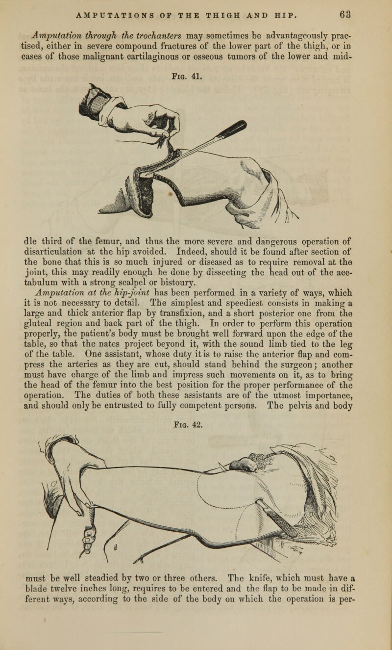 Amputation through the trochanters may sometimes be advantageously prac- tised, either in severe compound fractures of the lower part of the thigh, or in cases of those malignant cartilaginous or osseous tumors of the lower and mid- Fio. 41. die third of the femur, and thus the more severe and dangerous operation of disarticulation at the hip avoided. Indeed, should it be found after section of the bone that this is so much injured or diseased as to require removal at the joint, this may readily enough be done by dissecting the head out of the ace- tabulum with a strong scalpel or bistoury. Amputation at the hip-joint has been performed in a variety of ways, which it is not necessary to detail. The simplest and speediest consists in making a large and thick anterior flap by transfixion, and a short posterior one from the gluteal region and back part of the thigh. In order to perform this operation properly, the patient's body must be brought well forward upon the edge of the table, so that the nates project beyond it, with the sound limb tied to the leg of the table. One assistant, whose duty it is to raise the anterior flap and com- press the arteries as they are cut, should stand behind the surgeon; another must have charge of the limb and impress such movements on it, as to bring the head of the femur into the best position for the proper performance of the operation. The duties of both these assistants are of the utmost importance, and should only be entrusted to fully competent persons. The pelvis and body Fig. 42. must be well steadied by two or three others. The knife, which must have a blade twelve inches long, requires to be entered and the flap to be made in dif- ferent ways, according to the side of the body on which the operation is per-