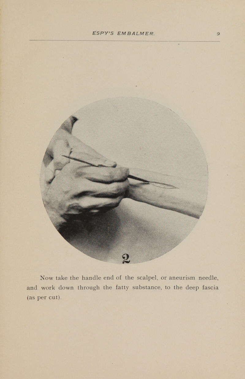 Now take the handle end of the scalpel, or aneurism needle, and work down through the fatty substance, to the deep fascia (as per cut).