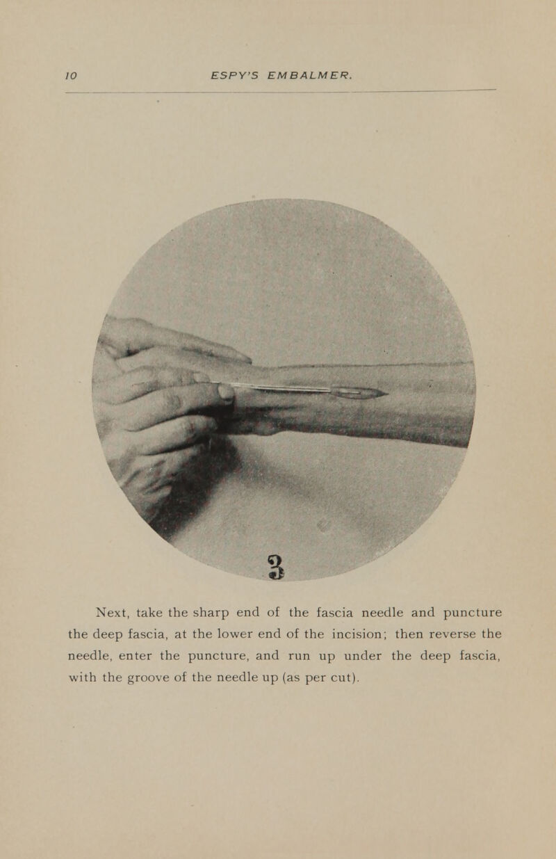 % Next, take the sharp end of the fascia needle and puncture the deep fascia, at the lower end of the incision; then reverse the needle, enter the puncture, and run up under the deep fascia, with the groove of the needle up (as per cut).