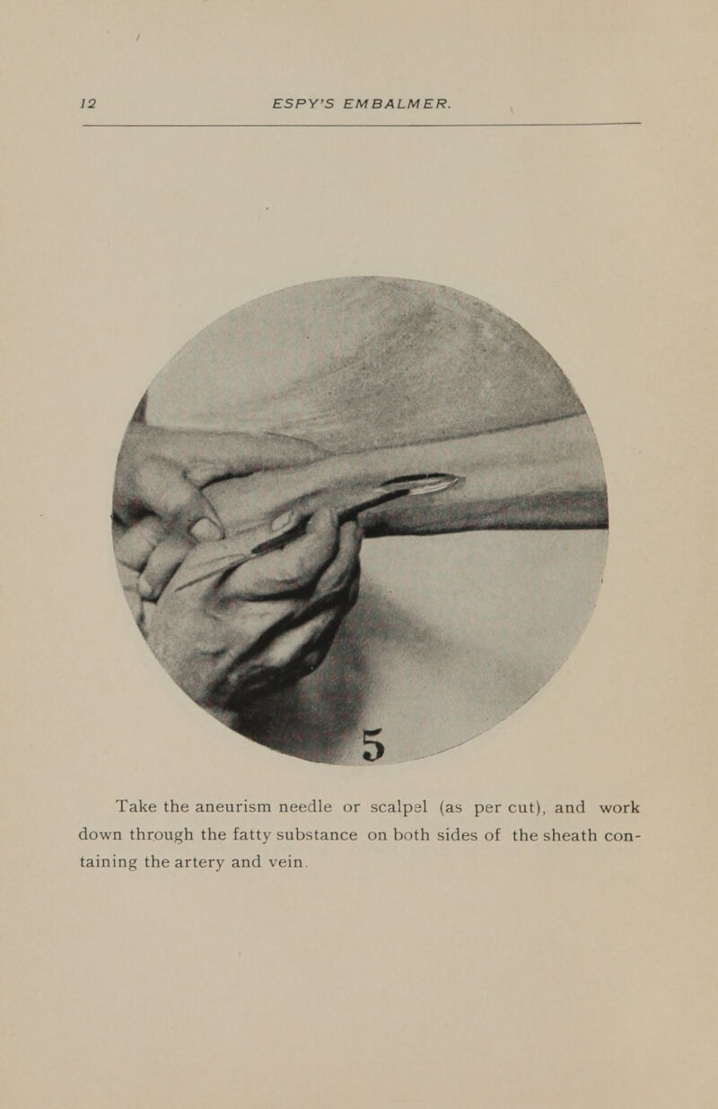 Take the aneurism needle or scalpel (as per cut), and work down through the fatty substance on both sides of the sheath con- taining the artery and vein.
