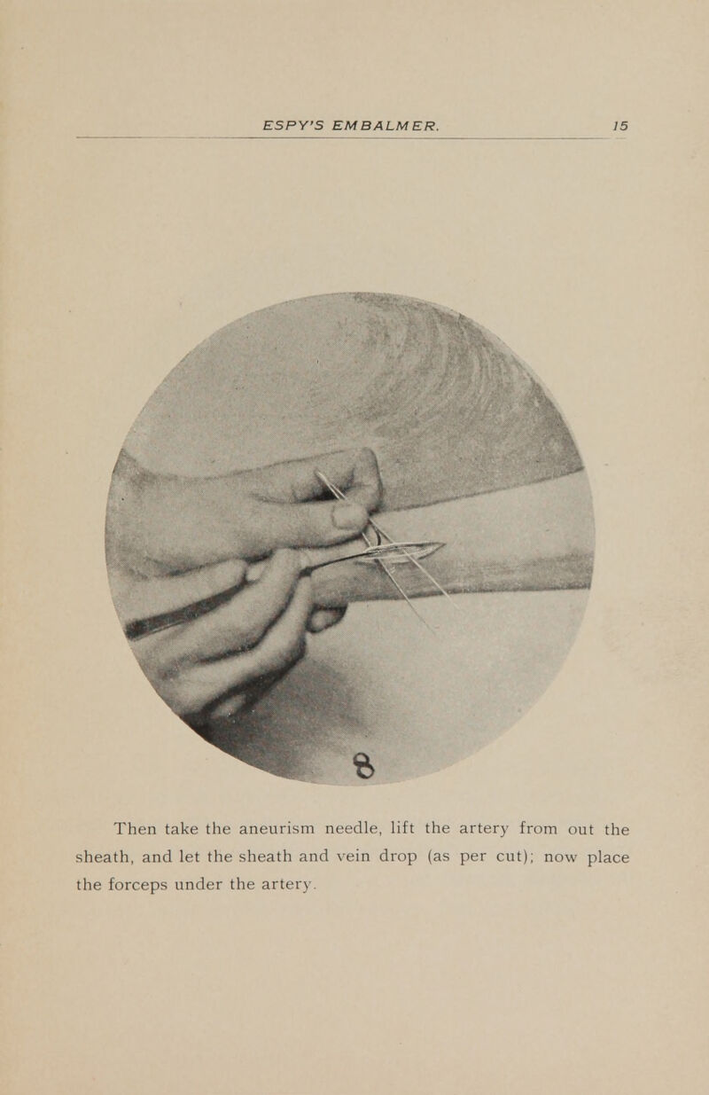 Then take the aneurism needle, lift the artery from out the sheath, and let the sheath and vein drop (as per cut); now place the forceps under the artery.