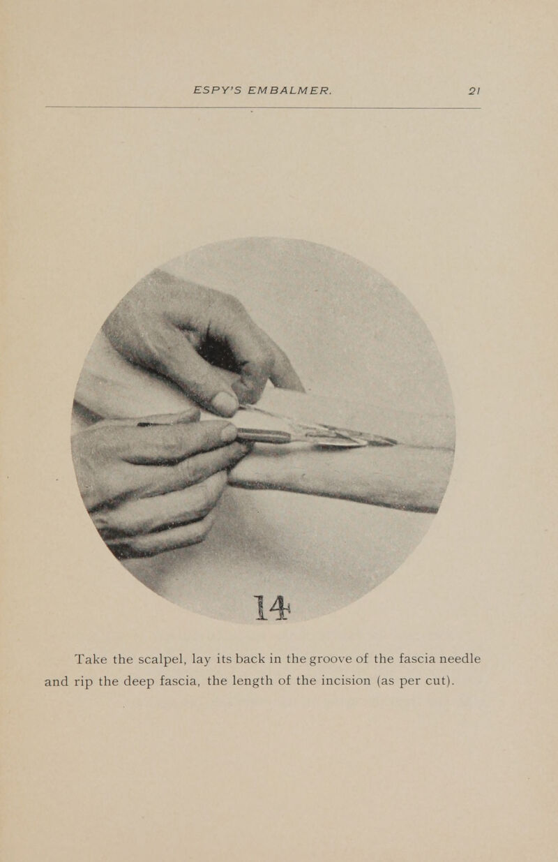 Take the scalpel, lay its back in the groove of the fascia needle and rip the deep fascia, the length of the incision (as per cut).