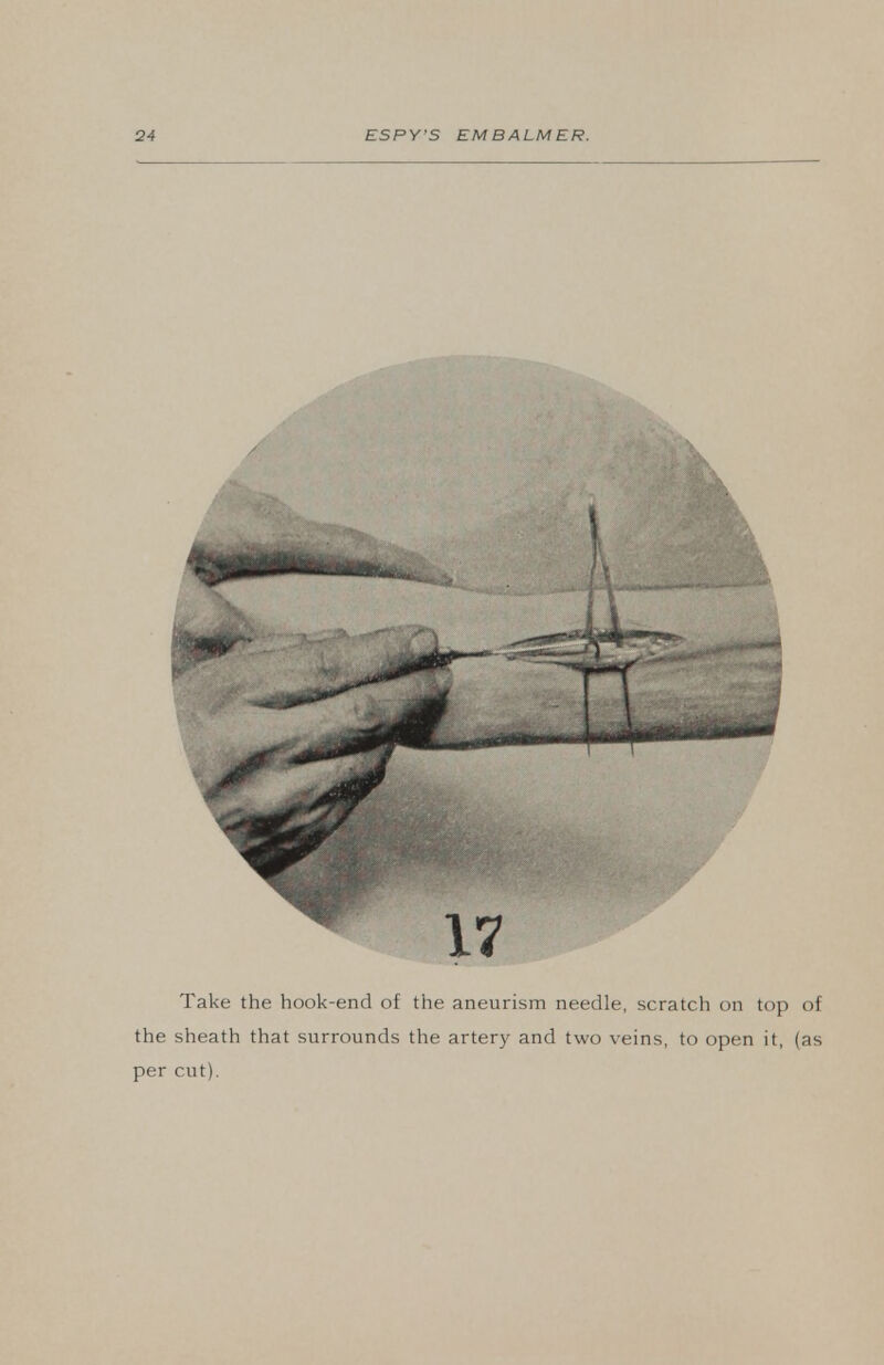 Take the hook-end of the aneurism needle, scratch on top of the sheath that surrounds the artery and two veins, to open it, (as