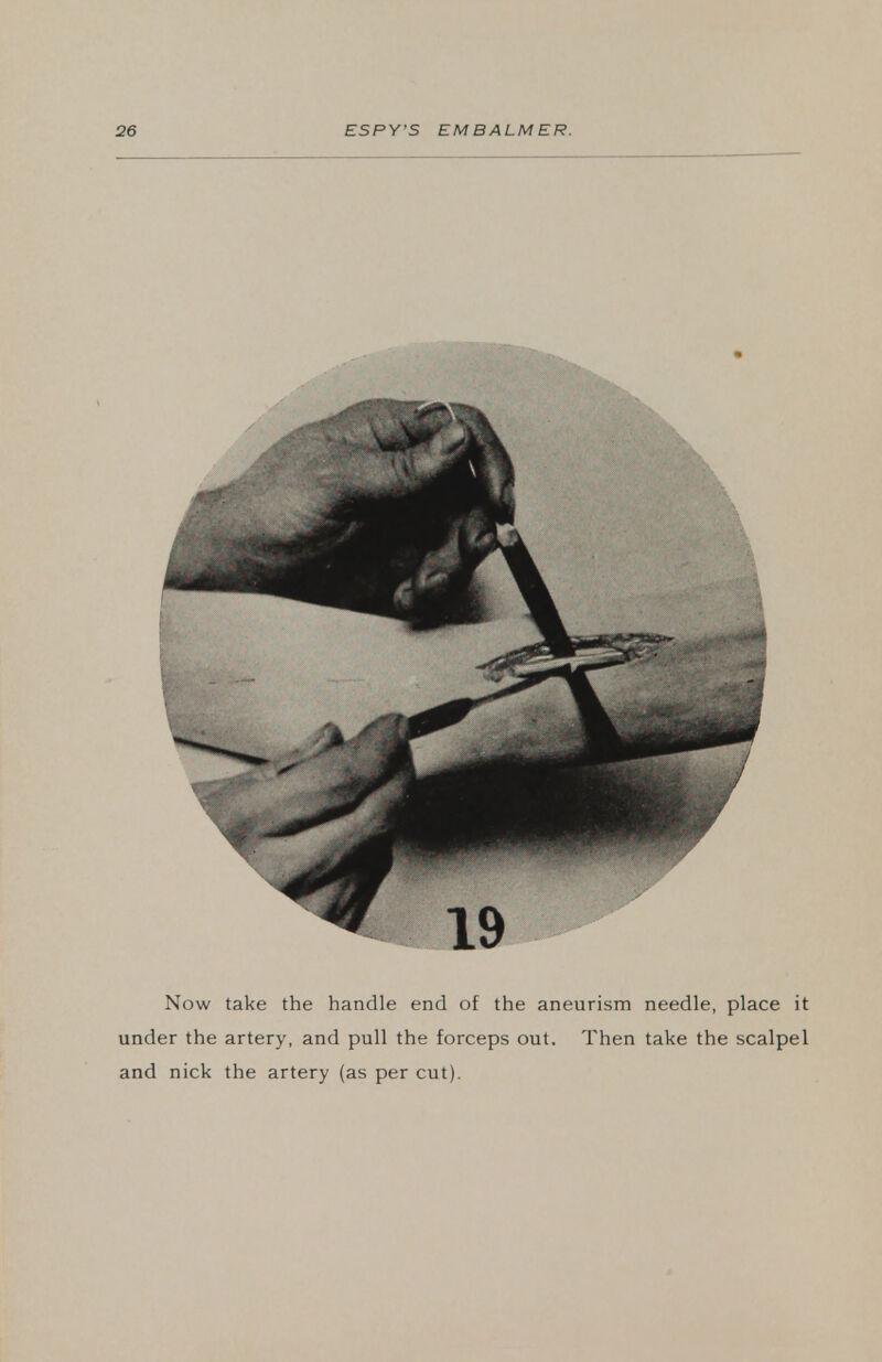 Now take the handle end of the aneurism needle, place it under the artery, and pull the forceps out. Then take the scalpel and nick the artery (as per cut).