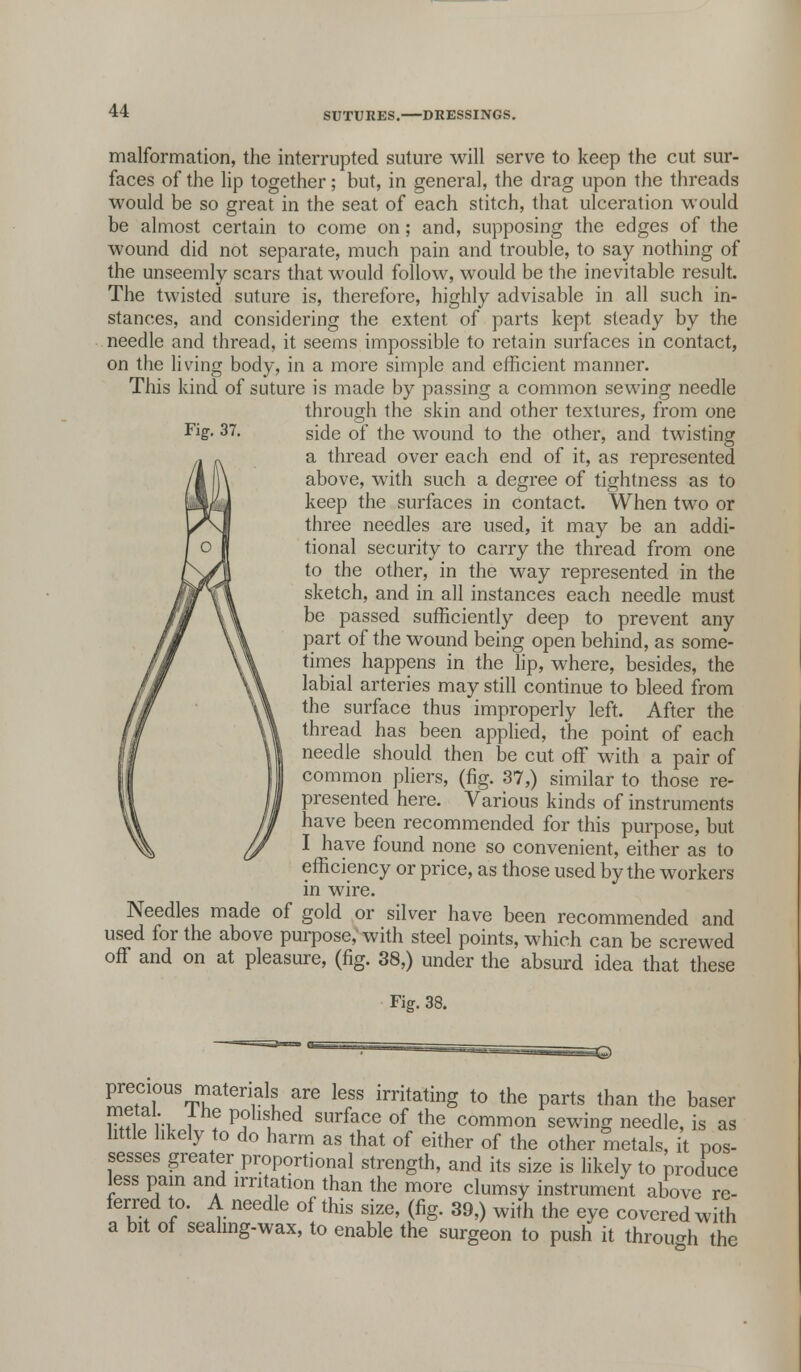 Fig-. 37. malformation, the interrupted suture will serve to keep the cut sur- faces of the lip together; but, in general, the drag upon the threads would be so great in the seat of each stitch, that ulceration would be almost certain to come on; and, supposing the edges of the wound did not separate, much pain and trouble, to say nothing of the unseemly scars that would follow, would be the inevitable result. The twisted suture is, therefore, highly advisable in all such in- stances, and considering the extent of parts kept steady by the needle and thread, it seems impossible to retain surfaces in contact, on the living body, in a more simple and efficient manner. This kind of suture is made by passing a common sewing needle through the skin and other textures, from one side of the wound to the other, and twisting a thread over each end of it, as represented above, with such a degree of tightness as to keep the surfaces in contact. When two or three needles are used, it may be an addi- tional security to carry the thread from one to the other, in the way represented in the sketch, and in all instances each needle must be passed sufficiently deep to prevent any part of the wound being open behind, as some- times happens in the lip, where, besides, the labial arteries may still continue to bleed from the surface thus improperly left. After the thread has been applied, the point of each needle should then be cut off with a pair of common pliers, (fig. 37,) similar to those re- presented here. Various kinds of instruments have been recommended for this purpose, but I have found none so convenient, either as to efficiency or price, as those used by the workers in wire. Needles made of gold or silver have been recommended and used for the above purpose, with steel points, which can be screwed off and on at pleasure, (fig. 38,) under the absurd idea that these Fig. 38. precious materials are less irritating to the parts than the baser metal Ihe polished surface of the common sewing needle, is as little likely to do harm as that of either of the other metals, it pos- sesses greater proportional strength, and its size is likely to produce less pain and irritation than the more clumsy instrument above re- ferred to. A needle of this size, (fig. 39,) with the eye covered with a bit of sealing-wax, to enable the surgeon to push it through the