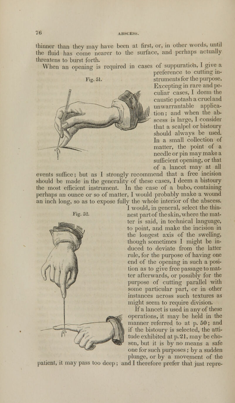thinner than they may have been at first, or, in other words, until the fluid has come nearer to the surface, and perhaps actually threatens to burst forth. When an opening is required in cases of suppuration, I give a preference to cutting in- Fig. 51. struments for the purpose. Excepting in rare and pe- culiar cases, I deem the caustic potash a cruel and unwarrantable applica- tion; and when the ab- scess is large, I consider that a scalpel or bistoury should always be used. In a small collection of matter, the point of a needle or pin may make a sufficient opening, or that of a lancet may at all events suffice; but as I strongly recommend that a free incision should be made in the generality of these cases, I deem a bistoury the most efficient instrument. In the case of a bubo, containing perhaps an ounce or so of matter, I would probably make a wound an inch long, so as to expose fully the whole interior of the abscess. I would, in general, select the thin- nest part of the skin, where the mat- ter is said, in technical language, to point, and make the incision in the longest axis of the swelling, though sometimes I might be in- duced to deviate from the latter rule, for the purpose of having one end of the opening in such a posi- tion as to give free passage to mat- ter afterwards, or possibly for the purpose of cutting parallel with some particular part, or in other instances across such textures as might seem to require division. If a lancet is used in any of these operations, it may be held in the manner referred to at p. 50; and if the bistoury is selected, the atti- tude exhibited at p. 21, may be cho- sen, but it is by no means a safe one for such purposes; by a sudden plunge, or by a movement of the patient, it may pass too deep; and I therefore prefer that just repre- Fig. 52.