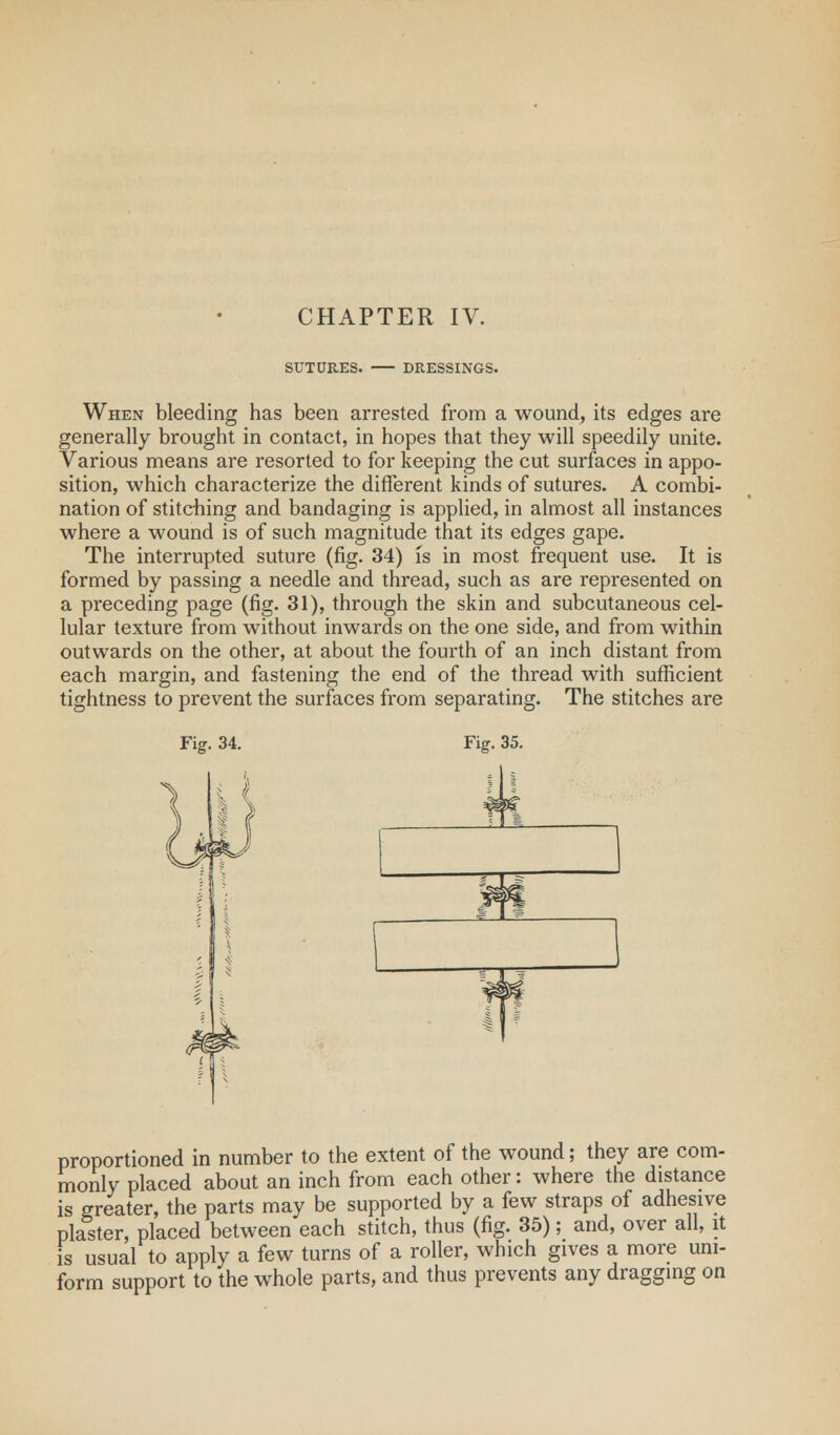 SUTURES. DRESSINGS. When bleeding has been arrested from a wound, its edges are generally brought in contact, in hopes that they will speedily unite. Various means are resorted to for keeping the cut surfaces in appo- sition, which characterize the different kinds of sutures. A combi- nation of stitching and bandaging is applied, in almost all instances where a wound is of such magnitude that its edges gape. The interrupted suture (fig. 34) is in most frequent use. It is formed by passing a needle and thread, such as are represented on a preceding page (fig. 31), through the skin and subcutaneous cel- lular texture from without inwards on the one side, and from within outwards on the other, at about the fourth of an inch distant from each margin, and fastening the end of the thread with sufficient tightness to prevent the surfaces from separating. The stitches are Fig. 34. Fig. 35. proportioned in number to the extent of the wound; they are com- monly placed about an inch from each other: where the distance is greater, the parts may be supported by a few straps of adhesive plaster, placed between each stitch, thus (fig. 35); and, over all, it is usual to apply a few turns of a roller, which gives a more uni- form support to the whole parts, and thus prevents any dragging on