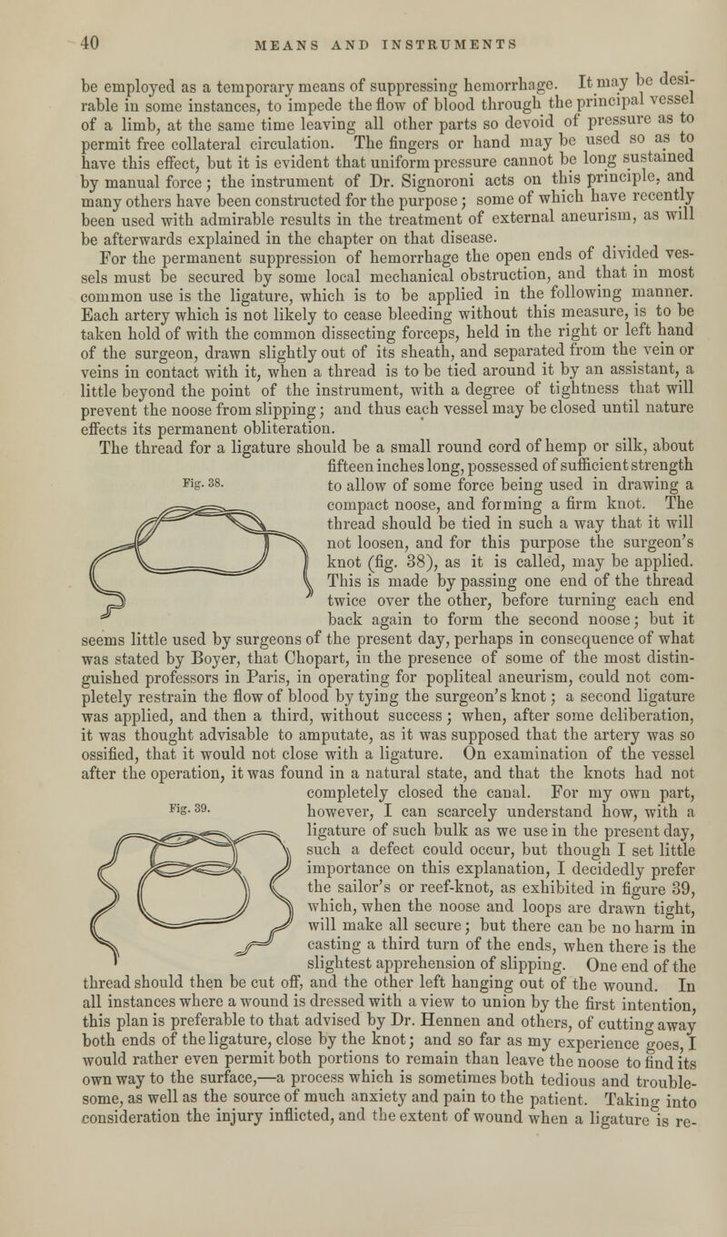 be employed as a temporary means of suppressing hemorrhage. It may be desi- rable in some instances, to impede the flow of blood through the principal vessel of a limb, at the same time leaving all other parts so devoid of pressure as to permit free collateral circulation. The fingers or hand may be used so as to have this effect, but it is evident that uniform pressure cannot be long sustained by manual force; the instrument of Dr. Signoroni acts on this principle, and many others have been constructed for the purpose; some of which have recently been used with admirable results in the treatment of external aneurism, as will be afterwards explained in the chapter on that disease. For the permanent suppression of hemorrhage the open ends of divided ves- sels must be secured by some local mechanical obstruction, and that in most common use is the ligature, which is to be applied in the following manner. Each artery which is not likely to cease bleeding without this measure, is to be taken hold of with the common dissecting forceps, held in the right or left hand of the surgeon, drawn slightly out of its sheath, and separated from the vein or veins in contact with it, when a thread is to be tied around it by an assistant, a little beyond the point of the instrument, with a degree of tightness that will prevent the noose from slipping; and thus each vessel may be closed until nature effects its permanent obliteration. The thread for a ligature should be a small round cord of hemp or silk, about fifteen inches long, possessed of sufficient strength Ks-38- to allow of some force being used in drawing a compact noose, and forming a firm knot. The thread should be tied in such a way that it will not loosen, and for this purpose the surgeon's knot (fig. 38), as it is called, may be applied. This is made by passing one end of the thread twice over the other, before turning each end back again to form the second noose; but it seems little used by surgeons of the present day, perhaps in consequence of what was stated by Boyer, that Chopart, in the presence of some of the most distin- guished professors in Paris, in operating for popliteal aneurism, could not com- pletely restrain the flow of blood by tying the surgeon's knot; a second ligature was applied, and then a third, without success; when, after some deliberation, it was thought advisable to amputate, as it was supposed that the artery was so ossified, that it would not close with a ligature. On examination of the vessel after the operation, it was found in a natural state, and that the knots had not completely closed the canal. For my own part, Fis-39- however, I can scarcely understand how, with a ligature of such bulk as we use in the present day, such a defect could occur, but though I set little importance on this explanation, I decidedly prefer the sailor's or reef-knot, as exhibited in figure 39, which, when the noose and loops are drawn tight, will make all secure; but there can be no harm in casting a third turn of the ends, when there is the slightest apprehension of slipping. One end of the thread should then be cut off, and the other left hanging out of the wound. In all instances where a wound is dressed with a view to union by the first intention this plan is preferable to that advised by Dr. Hennen and others, of cutting away both ends of the ligature, close by the knot; and so far as my experience goes I would rather even permit both portions to remain than leave the noose to find its own way to the surface,—a process which is sometimes both tedious and trouble- some, as well as the source of much anxiety and pain to the patient. Takino- into consideration the injury inflicted, and the extent of wound when a ligature is re-