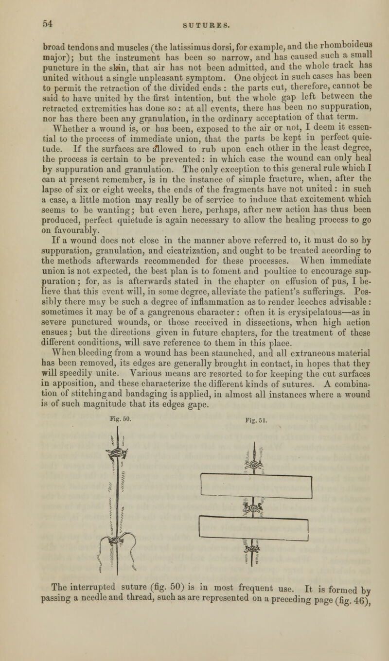 broad tendons and muscles (the latissimus dorsi, for example, and the rhoniboideus major); but the instrument has been so narrow, and has caused such a small puncture in the shin, that air has not been admitted, and the whole track has united without a single unpleasant symptom. One object in such cases has been to permit the retraction of the divided ends : the parts cut, therefore, cannot be said to have united by the first intention, but the whole gap left between the retracted extremities has done so: at all events, there has been no suppuration, nor has there been any granulation, in the ordinary acceptation of that term. Whether a wound is, or has been, exposed to the air or not, I deem it essen- tial to the process of immediate union, that the parts be kept in perfect quie- tude. If the surfaces are allowed to rub upon each other in the least degree, the process is certain to be prevented: in which case the wound can only heal by suppuration and granulation. The only exception to this general rule which I can at present remember, is in the instance of simple fracture, when, after the lapse of six or eight weeks, the ends of the fragments have not united: in such a case, a little motion may really be of service to induce that excitement which seems to be wanting; but even here, perhaps, after new action has thus been produced, perfect quietude is again necessary to allow the healing process to go on favourably. If a wound does not close in the manner above referred to, it must do so by suppuration, granulation, and cicatrization, and ought to be treated according to the methods afterwards recommended for these processes. When immediate union is not expected, the best plan is to foment and poultice to encourage sup- puration ; for, as is afterwards stated in the chapter on effusion of pus, I be- lieve that this event will, in some degree, alleviate the patient's sufferings. Pos- sibly there may be such a degree of inflammation as to render leeches advisable : sometimes it may be of a gangrenous character : often it is erysipelatous—as in severe punctured wounds, or those received in dissections, when high action ensues; but the directions given in future chapters, for the treatment of these different conditions, will save reference to them in this place. When bleeding from a wound has been staunched, and all extraneous material has been removed, its edges are generally brought in contact, in hopes that they will speedily unite. Various means are resorted to for keeping the cut surfaces in apposition, and these characterize the different kinds of sutures. A combina- tion of stitching and bandaging is applied, in almost all instances where a wound is of such magnitude that its edges gape. Fig. 50. Fig. 51. The interrupted suture (fig. 50) is in most frequent use. It is formed by ssing a needle and thread, such as are represented on a preceding page (fig. 46)
