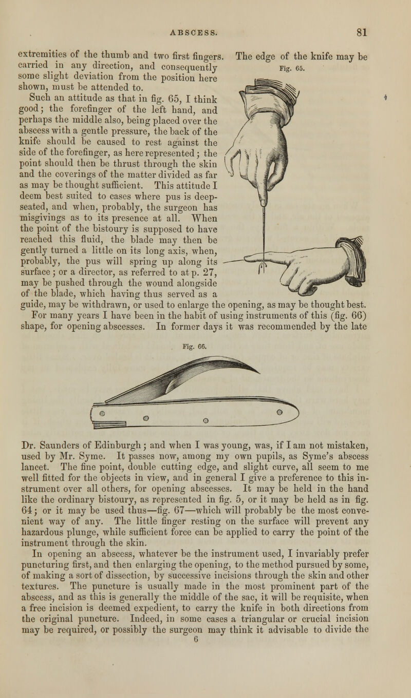 The edge of the knife may be Fig. 65. extremities of the thumb and two first fingers carried _ in any direction, and consequently some slight deviation from the position here shown, must be attended to. Such an attitude as that in fig. 65, I think good; the forefinger of the left hand, and perhaps the middle also, being placed over the abscess with a gentle pressure, the back of the knife should be caused to rest against the side of the forefinger, as here represented; the point should then be thrust through the skin and the coverings of the matter divided as far as may be thought sufficient. This attitude I deem best suited to cases where pus is deep- seated, and when, probably, the surgeon has misgivings as to its presence at all. When the point of the bistoury is supposed to have reached this fluid, the blade may then be gently turned a little on its long axis, when, probably, the pus will spring up along its surface; or a director, as referred to at p. 27, may be pushed through the wound alongside of the blade, which having thus served as a guide, may be withdrawn, or used to enlarge the opening, as may be thought best. For many years I have been in the habit of using instruments of this (fig. 66) shape, for opening abscesses. In former days it was recommended by the late Fig. 66. Dr. Saunders of Edinburgh ; and when I was young, was, if I am not mistaken, used by Mr. Syme. It passes now, among my own pupils, as Syme's abscess lancet. The fine point, double cutting edge, and slight curve, all seem to me well fitted for the objects in view, and in general I give a preference to this in- strument over all others, for opening abscesses. It may be held in the hand like the ordinary bistoury, as represented in fig. 5, or it may be held as in fig. 64; or it may be used thus—fig. 67—which will probably be the most conve- nient way of any. The little finger resting on the surface will prevent any hazardous plunge, while sufficient force can be applied to carry the point of the instrument through the skin. In opening an abscess, whatever be the instrument used, I invariably prefer puncturing first, and then enlarging the opening, to the method pursued by some, of making a sort of dissection, by successive incisions through the skin and other textures. The puncture is usually made in the most prominent part of the abscess, and as this is generally the middle of the sac, it will be requisite, when a free incision is deemed expedient, to carry the knife in both directions from the original puncture. Indeed, in some cases a triangular or crucial incision may be required, or possibly the surgeon may think it advisable to divide the 6