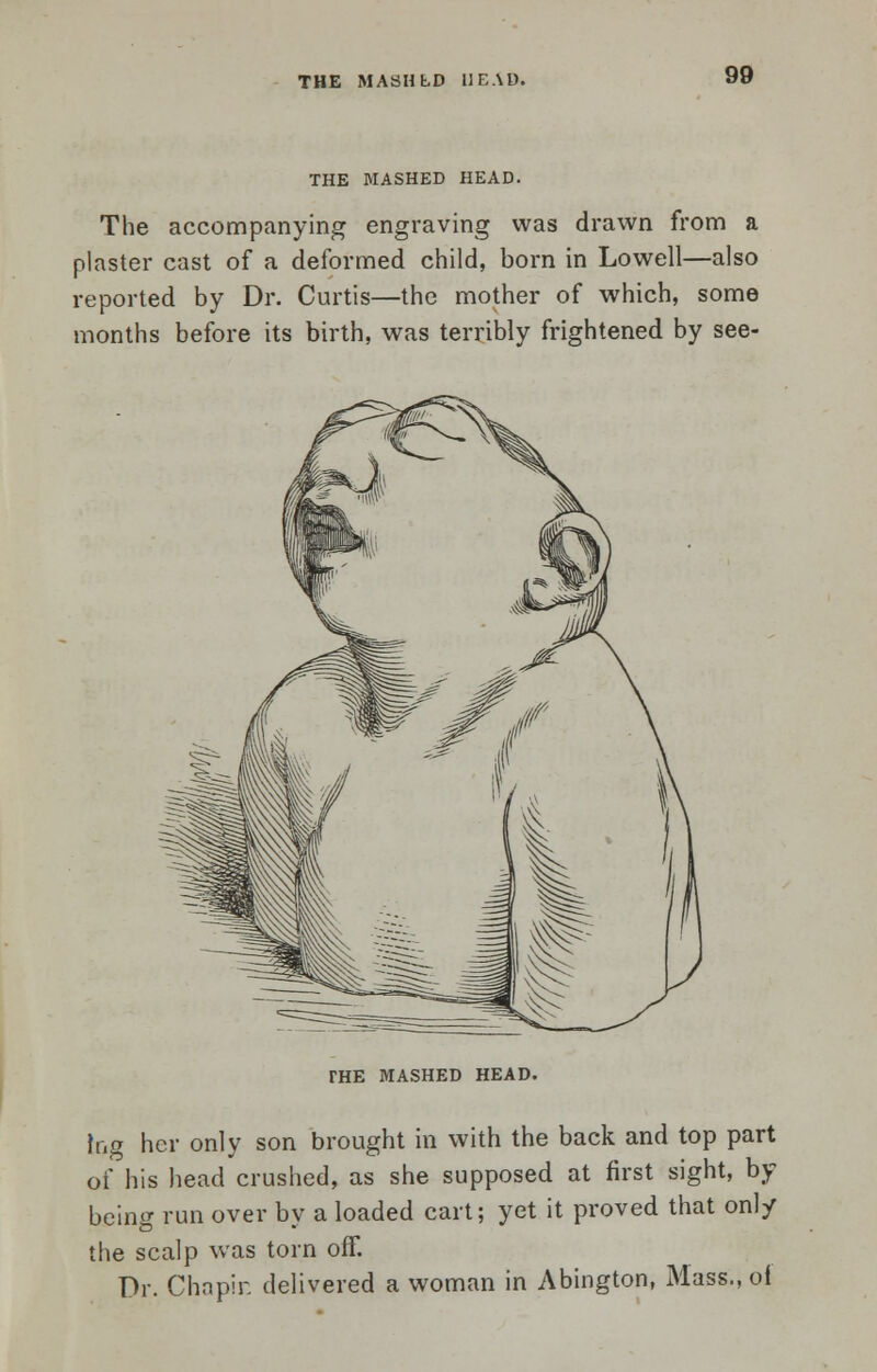 THE MASHED HEAD. The accompanying engraving was drawn from a plaster cast of a deformed child, born in Lowell—also reported by Dr. Curtis—the mother of which, some months before its birth, was terribly frightened by see- THE MASHED HEAD. tog her only son brought in with the back and top part of his head crushed, as she supposed at first sight, by- being run over by a loaded cart; yet it proved that only the scalp was torn off. Dr. Chapin delivered a woman in Abington, Mass., of