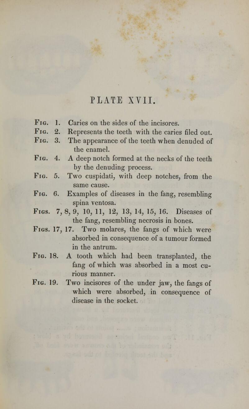 Fig. 1. Caries on the sides of the incisores. Fig. 2. Represents the teeth with the caries filed out. Fig. 3. The appearance of the teeth when denuded of the enamel. Fig. 4. A deep notch formed at the necks of the teeth by the denuding process. Fig. 5. Two cuspidati, with deep notches, from the same cause. Fig. 6. Examples of diseases in the fang, resembling spina ventosa. Figs. 7, 8, 9, 10, 11, 12, 13, 14, 15, 16. Diseases of the fang, resembling necrosis in bones. Figs. 17, 17. Two molares, the fangs of which were absorbed in consequence of a tumour formed in the antrum. Fig. 18. A tooth which had been transplanted, the fang of which was absorbed in a most cu- rious manner. Fig. 19. Two incisores of the under jaw, the fangs of which were absorbed, in consequence of disease in the socket.