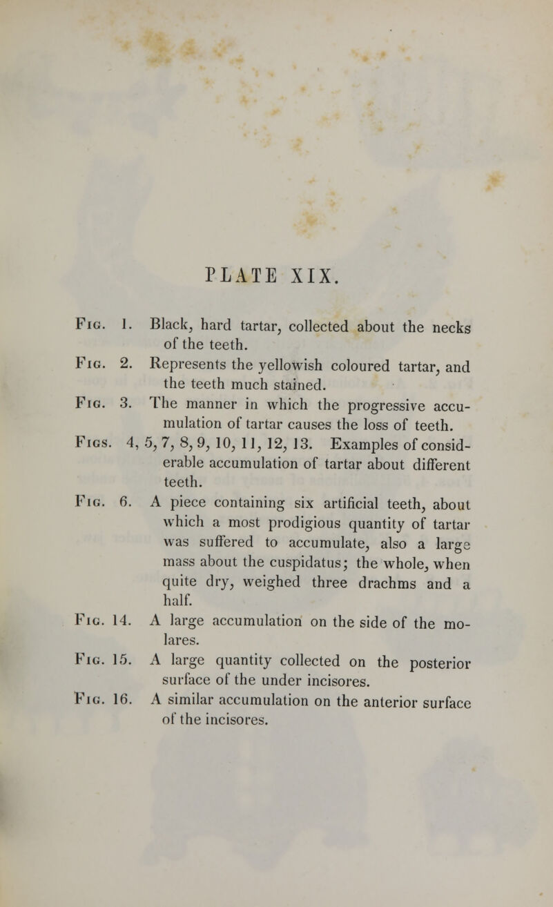 Fig. 1. Black, hard tartar, collected about the necks of the teeth. Fig. 2. Represents the yellowish coloured tartar, and the teeth much stained. Fig. 3. The manner in which the progressive accu- mulation of tartar causes the loss of teeth. Figs. 4,5,7,8,9,10,11,12,13. Examples of consid- erable accumulation of tartar about different teeth. Fig. 6. A piece containing six artificial teeth, about which a most prodigious quantity of tartar was suffered to accumulate, also a large mass about the cuspidatus; the whole, when quite dry, weighed three drachms and a half. Fig. 14. A large accumulation on the side of the mo- lares. Fig. 15. A large quantity collected on the posterior surface of the under incisores. Fig. 16. A similar accumulation on the anterior surface of the incisores.