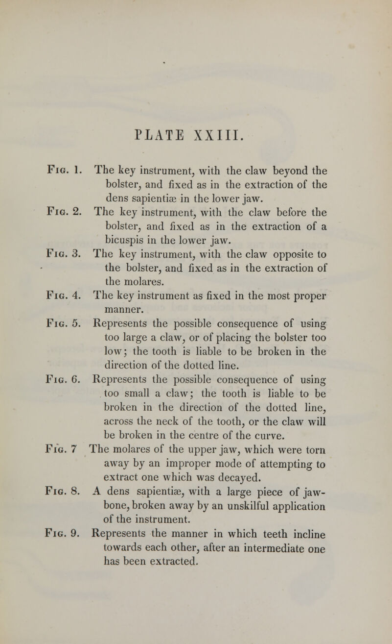 Fig. 1. The key instrument, with the claw beyond the bolster, and fixed as in the extraction of the dens sapientiae in the lower jaw. Fig. 2. The key instrument, with the claw before the bolster, and fixed as in the extraction of a bicuspis in the lower jaw. Fig. 3. The key instrument, with the claw opposite to the bolster, and fixed as in the extraction of the molares. Fig. 4. The key instrument as fixed in the most proper manner. Fig. 5. Represents the possible consequence of using too large a claw, or of placing the bolster too low; the tooth is liable to be broken in the direction of the dotted line. Fig. 6. Represents the possible consequence of using too small a claw; the tooth is liable to be broken in the direction of the dotted line, across the neck of the tooth, or the claw will be broken in the centre of the curve. Fig. 7 The molares of the upper jaw, which were torn away by an improper mode of attempting to extract one which was decayed. Fig. 8. A dens sapientiae, with a large piece of jaw- bone, broken away by an unskilful application of the instrument. Fig. 9. Represents the manner in which teeth incline towards each other, after an intermediate one has been extracted.
