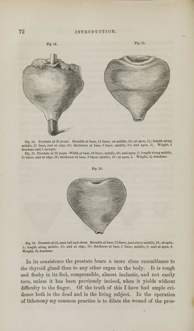 Fig. 14. Fig. 15. m Fig. 14. Prostate at 20 years. Breadth at base, 14 lines; at middle, 16; at apex, 5£; length along middle, 15 lines, and at edge, 16; thickness at base, 8 lines; middle, 10; and apex, 5^. Weight, 4 drachms and 1 scruple. Fig. 15. Prostate at 25 years. Width at base, 18 lines; middle, 20; and apex, 5; length along middle, 15 lines; and at edge, 18; thickness at base, 9 lines; middle, 10; at apex, 4. Weight, 4i drachms. Fig. 16. Fig. 16. Prostate at 52, man tall and stout. Breadth at base, 12 lines; just above middle, 18; at apex, 5; length along middle, 15; and at edge, 18; thickness at base, 5 lines; middle, 8; and at apex, 4. Weight, 3j drachms. In its consistence the prostate bears a more close resemblance to the thyroid gland than to any other organ in the body. It is tough and fleshy in its feel, compressible, almost inelastic, and not easily torn, unless it has been previously incised, when it yields without difficulty to the finger. Of the truth of this I have had ample evi- dence both in the dead and in the living subject. In the operation of lithotomy my common practice is to dilate the wound of the pros-