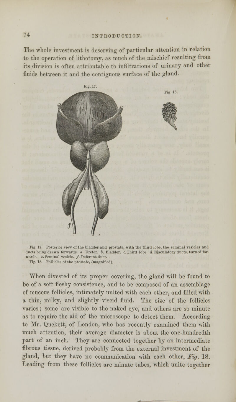 The wliole investment is deserving of particular attention in relation to the operation of lithotomy, as much of the mischief resulting from its division is often attributable to infiltrations of urinary and other fluids between it and the contiguous surface of the gland. Fig. 18. Fig. 17. Posterior view of the bladder and prostate, with the third lobe, the seminal vesicles and ducts being drawn forwards, a. Ureter, b. Bladder, c. Third lobe. d. Ejaculatory ducts, turned for- wards, e. Seminal vesicle. /. Deferent duct. Fig. 18. Follicles of the prostate, (magnified). When divested of its proper covering, the gland will be found to be of a soft fleshy consistence, and to be composed of an assemblage of mucous follicles, intimately united with each other, and filled with a thin, milky, and slightly viscid fluid. The size of the follicles varies; some are visible to the naked eye, and others are so minute as to require the aid of the microscope to detect them. According to Mr. Quekett, of London, who has recently examined them with much attention, their average diameter is about the one-hundredth part of an inch. They are connected together by an intermediate fibrous tissue, derived probably from the external investment of the gland, but they have no communication with each other, Fig. 18. Leading from these follicles are minute tubes, which unite together