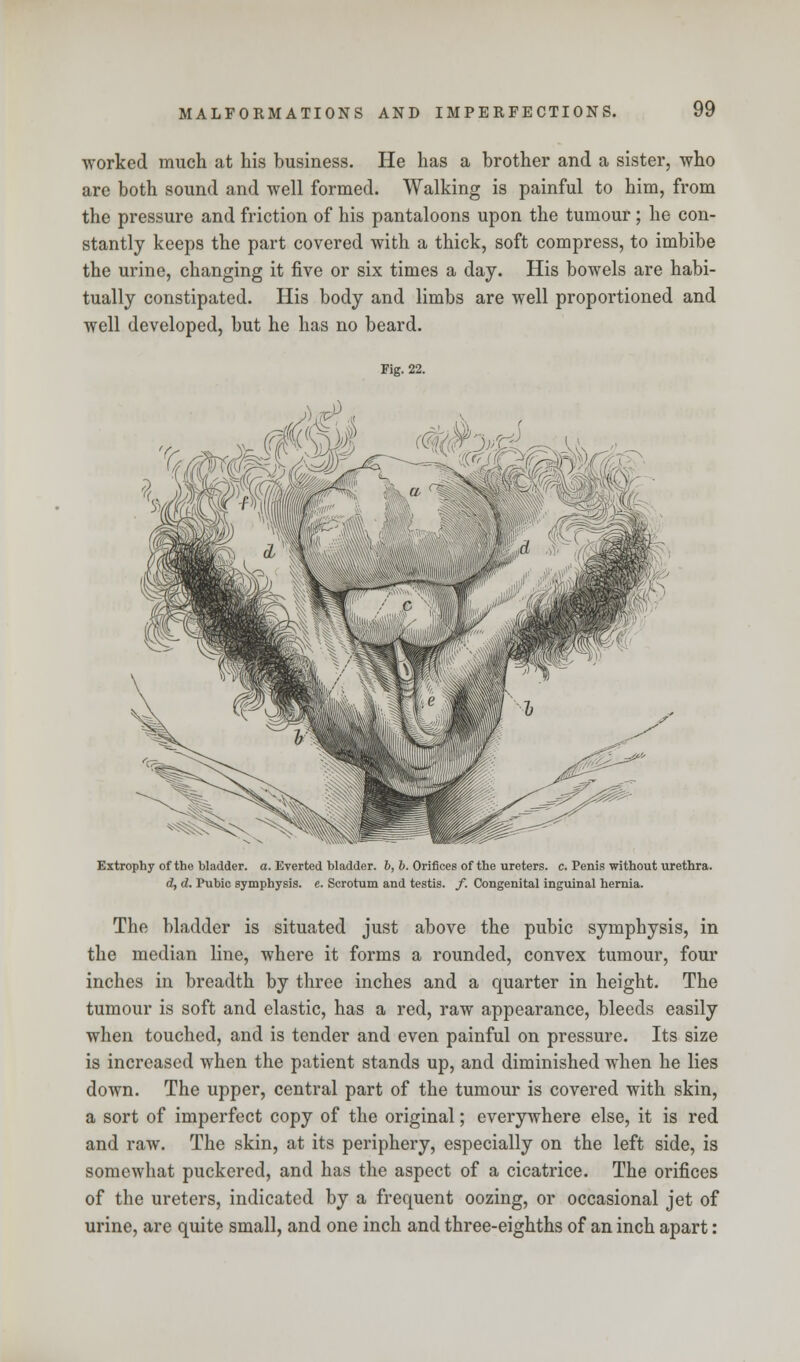 worked much at his business. He has a brother and a sister, who are both sound and well formed. Walking is painful to him, from the pressure and friction of his pantaloons upon the tumour; he con- stantly keeps the part covered with a thick, soft compress, to imbibe the urine, changing it five or six times a day. His bowels are habi- tually constipated. His body and limbs are well proportioned and well developed, but he has no beard. Fig. 22. Extrophy of the bladder, a. Everted bladder. 6, b. Orifices of the ureters, c. Penis without urethra. d, d. Pubic symphysis, e. Scrotum and testis. /. Congenital inguinal hernia. The bladder is situated just above the pubic symphysis, in the median line, where it forms a rounded, convex tumour, four inches in breadth by three inches and a quarter in height. The tumour is soft and elastic, has a red, raw appearance, bleeds easily when touched, and is tender and even painful on pressure. Its size is increased when the patient stands up, and diminished when he lies down. The upper, central part of the tumour is covered with skin, a sort of imperfect copy of the original; everywhere else, it is red and raw. The skin, at its periphery, especially on the left side, is somewhat puckered, and has the aspect of a cicatrice. The orifices of the ureters, indicated by a frequent oozing, or occasional jet of urine, are quite small, and one inch and three-eighths of an inch apart: