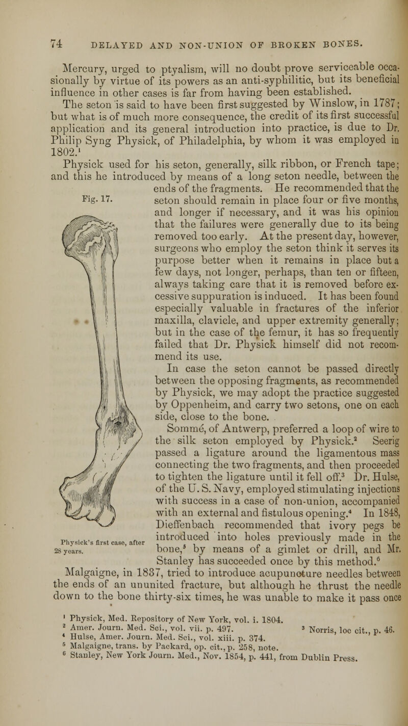 Fig. 17. Mercury, urged to ptyalism, will no doubt prove serviceable occa- sionally by virtue of its'powers as an anti-syphilitic, but its beneficial influence in other cases is far from having been established. The seton is said to have been first suggested by Winslow, in 1787; but what is of much more consequence, the credit of its first successful application and its general introduction into practice, is due to Dr. Philip Syng Physick, of Philadelphia, by whom it was employed in 1802.' Physick used for his seton, generally, silk ribbon, or French tape; and this he introduced by means of a long seton needle, between the ends of the fragments. He recommended that the seton should remain in place four or five months, and longer if necessary, and it was his opinion that the failures were generally due to its being removed too early. At the present day, however, surgeons who employ the seton think it serves its purpose better when it remains in place but a few days, not longer, perhaps, than ten or fifteen, always taking care that it is removed before ex- cessive suppuration is induced. It has been found especially valuable in fractures of the inferior maxilla, clavicle, and upper extremity generally; but in the case of the femur, it has so frequently failed that Dr. Physick himself did not recom- mend its use. In case the seton cannot be passed directly between the opposing fragments, as recommended by Physick, we may adopt the practice suggested by Oppenheim, and carry two setons, one on each side, close to the bone. Somme, of Antwerp, preferred a loop of wire to the silk seton employed by Physick.2 Seerig passed a ligature around the ligamentous mass connecting the two fragments, and then proceeded to tighten the ligature until it fell off.3 Dr. Hulse, of the U. S. Navy, employed stimulating injections with success in a case of non-union, accompanied with an external and fistulous opening.4 In 1848, Dieffenbach recommended that ivory pegs be introduced into holes previously made in the boue,s by means of a gimlet or drill, and Mr. Stanley has succeeded once by this method.6 Malgaigne, in 1837, tried to introduce acupuncture needles between the ends of an ununited fracture, but although he thrust the needle down to the bone thirty-six times, he was unable to make it pass once Physick's first case, after 28 years. 3 Norris, loc cit., p. 46. 1 Physick, Med. Repository of New York, vol. i. 1804. 2 Amer. Journ. Med. Sci., vol. vii. p. 497. 4 Hulse, Amer. Journ. Med. Sci., vol. xiii. p. 374. 5 Malgaigne, trans, by Packard, op. cit., p. 258, note. 6 Stanley, New York Journ. Med., Nov. 1854, p. 441, from Dublin Press.