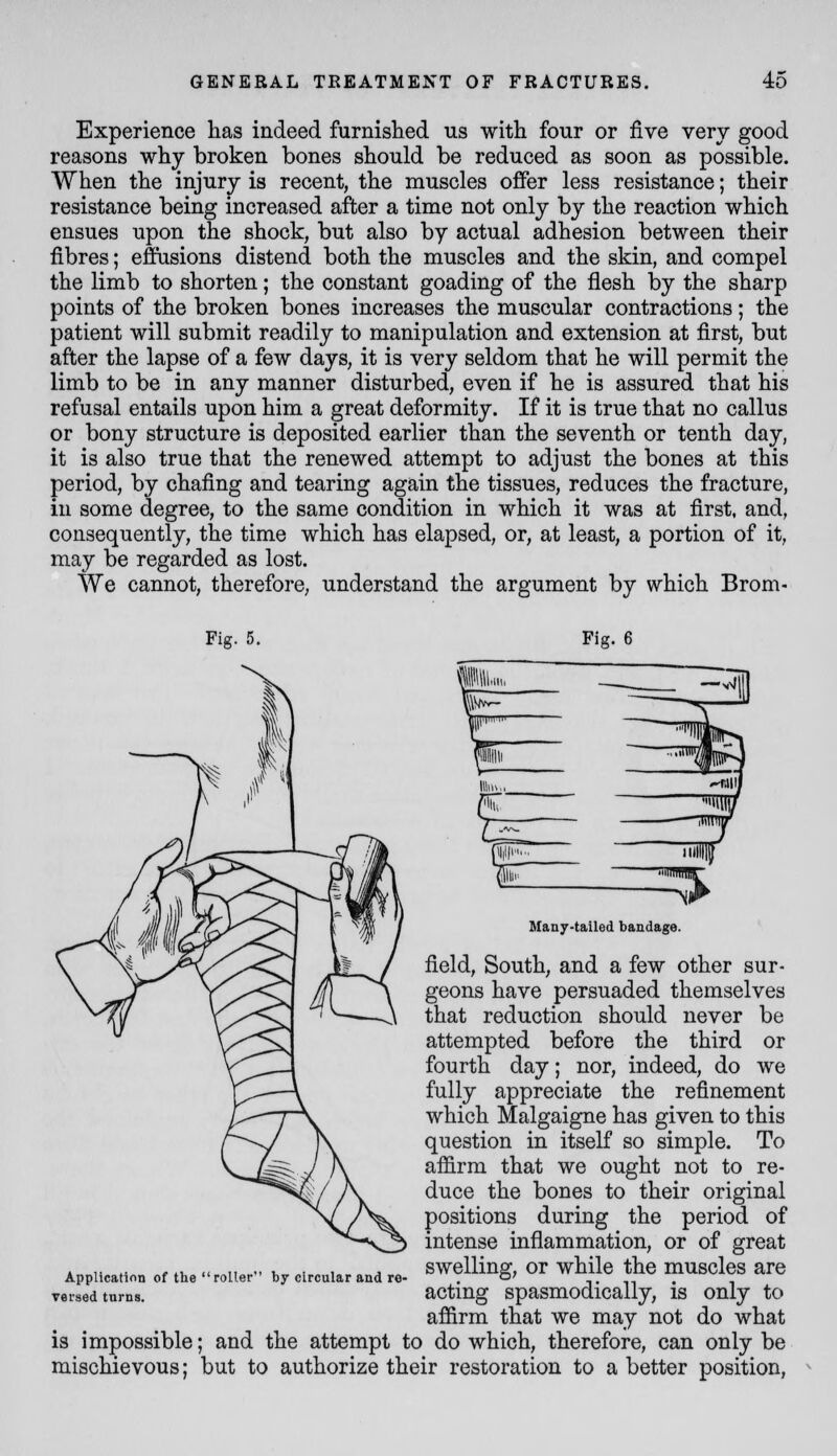 Experience has indeed furnished us with four or five very good reasons why broken bones should be reduced as soon as possible. When the injury is recent, the muscles offer less resistance; their resistance being increased after a time not only by the reaction which ensues upon the shock, but also by actual adhesion between their fibres; effusions distend both the muscles and the skin, and compel the limb to shorten; the constant goading of the flesh by the sharp points of the broken bones increases the muscular contractions; the patient will submit readily to manipulation and extension at first, but after the lapse of a few days, it is very seldom that he will permit the limb to be in any manner disturbed, even if he is assured that his refusal entails upon him a great deformity. If it is true that no callus or bony structure is deposited earlier than the seventh or tenth day, it is also true that the renewed attempt to adjust the bones at this period, by chafing and tearing again the tissues, reduces the fracture, in some degree, to the same condition in which it was at first, and, consequently, the time which has elapsed, or, at least, a portion of it, may be regarded as lost. We cannot, therefore, understand the argument by which Brom- Fig. 5. Fig. 6 Many-tailed bandage. field. South, and a few other sur- geons have persuaded themselves that reduction should never be attempted before the third or fourth day; nor, indeed, do we fully appreciate the refinement which Malgaigne has given to this question in itself so simple. To affirm that we ought not to re- duce the bones to their original positions during the period of intense inflammation, or of great swelling, or while the muscles are acting spasmodically, is only to affirm that we may not do what is impossible; and the attempt to do which, therefore, can only be mischievous; but to authorize their restoration to a better position, Application of the roller by circular and re versed turns.
