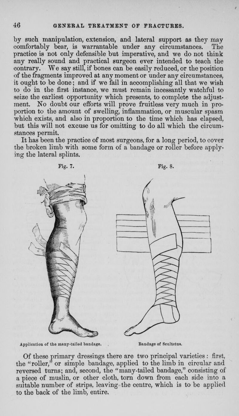 by sucli manipulation, extension, and lateral support as they may comfortably bear, is warrantable under any circumstances. The practice is not only defensible but imperative, and we do not think any really sound and practical surgeon ever intended to teach the contrary. We say still, if bones can be easily reduced, or the position of the fragments improved at any moment or under any circumstances, it ought to be done; and if we fail in accomplishing all that we wish to do in the first instance, we must remain incessantly watchful to seize the earliest opportunity which presents, to complete the adjust- ment. No doubt our efforts will prove fruitless very much in pro- portion to the amount of swelling, inflammation, or muscular spasm which exists, and also in proportion to the time which has elapsed, but this will not excuse us for omitting to do all which the circum- stances permit. It has been the practice of most surgeons, for a long period, to cover the broken limb with some form of a bandage or roller before apply- ing the lateral splints. Fig. 7. Fig. 8. Application of the many-tailed bandage. Bandage of Scultetus. Of these primary dressings there are two principal varieties : first, the roller, or simple bandage, applied to the limb in circular and reversed turns; and, second, the many-tailed bandage, consisting of a piece of muslin, or other cloth, torn down from each side into a suitable number of strips, leaving the centre, which is to be applied to the back of the limb, entire.