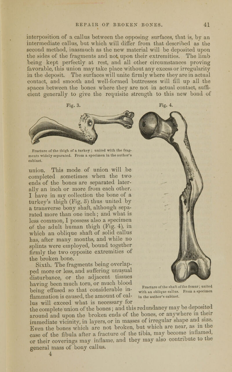 interposition of a callus between the opposing surfaces, that is, by an intermediate callus, but which will differ from that described as the second method, inasmuch as the new material will be deposited upon the sides of the fragments and not upon their extremities. The limb being kept perfectly at rest, and all other circumstances proving favorable, this union may take place without any excess or irregularity in the deposit. The surfaces will unite firmly where they are in actual contact, and smooth and well-formed buttresses will fill up all the spaces between the bones where they are not in actual contact, suffi- cient generally to give the requisite strength to this new bond of Fig. 3. Fig. 4. Fracture of the thigh of a turkey ; united with the frag- ments widely separated. From a specimen in the author's cabinet. union. This mode of union will be completed sometimes when the two ends of the bones are separated later- ally an inch or more from each other. I have in my collection the bone of a turkey's thigh (Fig. 8) thus united by a transverse bony shaft, although sepa- rated more than one inch; and what is less common, I possess also a specimen of the adult human thigh (Fig. 4), in which an oblique shaft of solid callus has, after many months, and while no splints were employed, bound together firmly the two opposite extremities of the broken bone. Sixth. The fragments being overlap- ped more or less, and suffering unusual disturbance, or the adjacent tissues having been much torn, or much blood being effused so that considerable in- flammation is caused, the amount of cal- lus will exceed what is necessary for the complete union of the bones; and this redundancy may be deposited around and upon the broken ends of the bones, or anywhere m their immediate vicinitv, in layers, or in masses of irregular shape and size. Even the bones which are not broken, but which are near, as in the case of the fibula after a fracture of the tibia, may become inflamed, or their coverings may inflame, and they may also contribute to the general mass of bony callus. 4 Fracture of the shaft of the femur; united with an oblique callus. From a specimen in the author's cabinet.