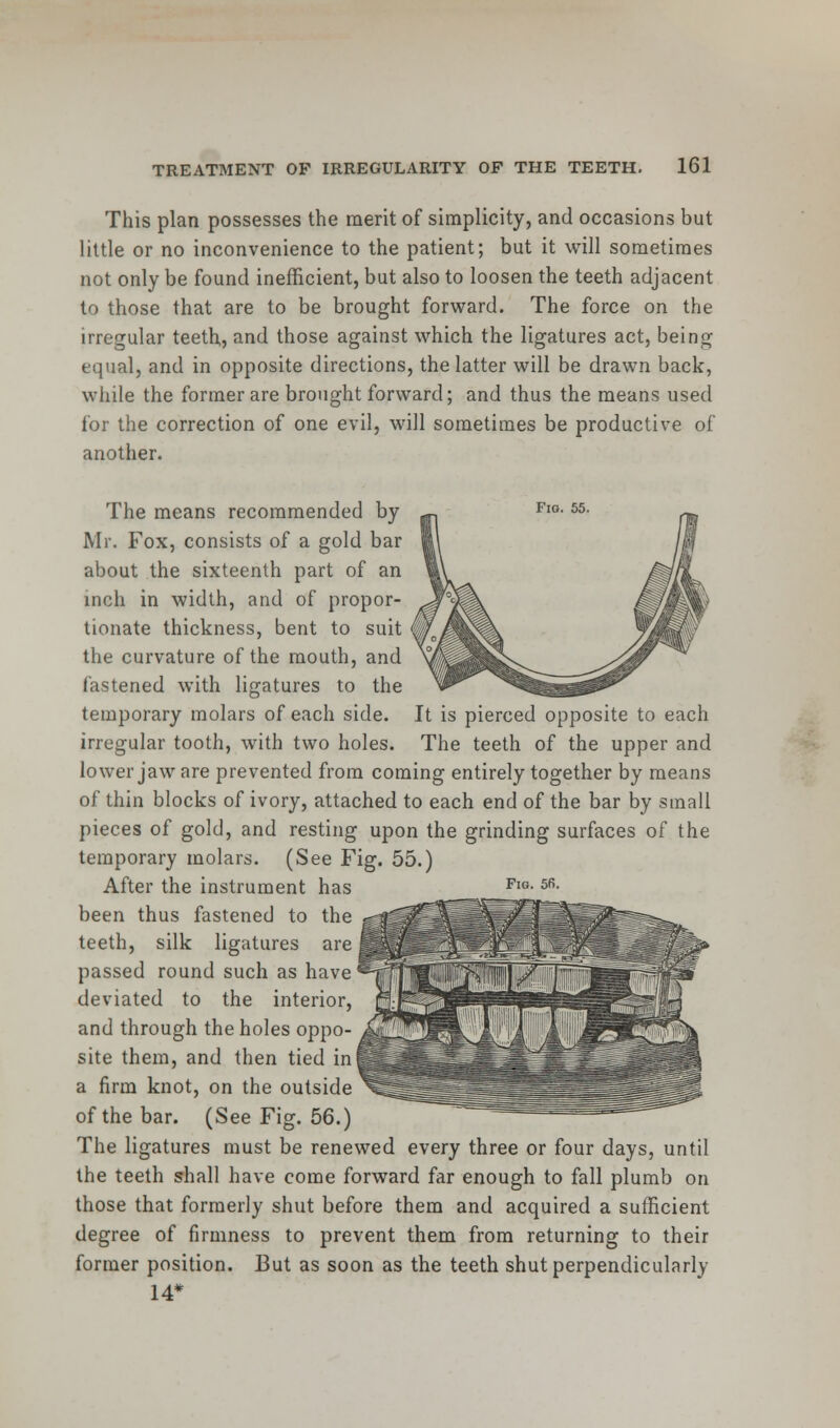 This plan possesses the merit of simplicity, and occasions but little or no inconvenience to the patient; but it will sometimes not only be found inefficient, but also to loosen the teeth adjacent to those that are to be brought forward. The force on the irregular teeth, and those against which the ligatures act, being equal, and in opposite directions, the latter will be drawn back, while the former are brought forward; and thus the means used for the correction of one evil, will sometimes be productive of another. It is pierced opposite to each The teeth of the upper and Fig. 5fi. The means recommended by - Mr. Fox, consists of a gold bar about the sixteenth part of an inch in width, and of propor- tionate thickness, bent to suit the curvature of the mouth, and fastened with ligatures to the temporary molars of each side. irregular tooth, with two holes, lower jaw are prevented from coming entirely together by means of thin blocks of ivory, attached to each end of the bar by small pieces of gold, and resting upon the grinding surfaces of the temporary molars. (See Fig. 55.) After the instrument has been thus fastened to the teeth, silk ligatures are passed round such as have deviated to the interior, and through the holes oppo- site them, and then tied in a firm knot, on the outside of the bar. (See Fig. 56.) The ligatures must be renewed every three or four days, until the teeth shall have come forward far enough to fall plumb on those that formerly shut before them and acquired a sufficient degree of firmness to prevent them from returning to their former position. But as soon as the teeth shut perpendicularly 14*