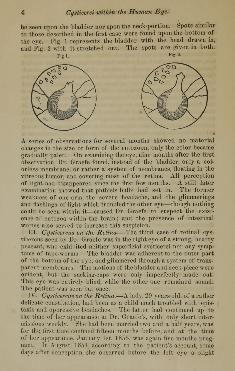 be seen upon the bladder nor upon the neck-portion. Spots similar to those described in the first case were found upon the bottom of the eye. Fig. 1 represents the bladder with the head drawn in, and Fig. 2 with it stretched out. The spots are given in both. Fig 1. Fig. 2. A series of observations for several months showed no material changes in the size or form of the entozoon, only the color became gradually paler. On examining the eye, nine months after the first observation, Dr. Graefe found, instead of the bladder, only a col- orless membrane, or rather a system of membranes, floating in the vitreous humor, and covering most of the retina. All perception of light had disappeared since the first few months. A still later examination showed that phthisis bulbi had set in. The former weakness of one arm, the severe headache, and the glimmerings and flashings of light which troubled the other eye—though nothing could be seen within it—caused Dr. Graefe to suspect the exist- ence of entozoa within the brain; and the presence of intestinal worms also served to increase this suspicion. III. Cysticercus on the Retina.—The third case of retinal cys- ticercus seen by Dr. Graefe was in the right eye of a strong, hearty peasant, who exhibited neither superficial cysticerci nor any symp- toms of tape-worms. The bladder was adherent to the outer part of the bottom of the eye, and glimmered through a system of trans- parent membranes. The motions of the bladder and neck-piece were evident, but the sucking-cups were only imperfectly made out. This eye was entirely blind, while the other one remained sound. The patient was seen but once. IV. Cysticercus on the Retina.—A lady, 20 years old, of a rather delicate constitution, had been as a child much troubled with epis- taxis and oppressive headaches. The latter had continued up to the time of her appearance at Dr. Graefe's, with only short inter- missions weekly. She had been married two and a half years, was for the first time confined fifteen months before, and at the time of her appearance, January 1st, 1855, was again five mouths preg- nant. In August, 1854, according to the patient's account, some days after conception, she observed before the left eye a slight