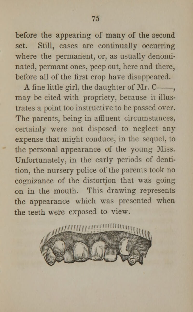 before the appearing of many of the second set. Still, cases are continually occurring where the permanent, or, as usually denomi- nated, permant ones, peep out, here and there, before all of the first crop have disappeared. A fine little girl, the daughter of Mr. C , may be cited with propriety, because it illus- trates a point too instructive to be passed over. The parents, being in affluent circumstances, certainly were not disposed to neglect any expense that might conduce, in the sequel, to the personal appearance of the young Miss. Unfortunately, in the early periods of denti- tion, the nursery police of the parents took no cognizance of the distortion that was going on in the mouth. This drawing represents the appearance which was presented when the teeth were exposed to view.