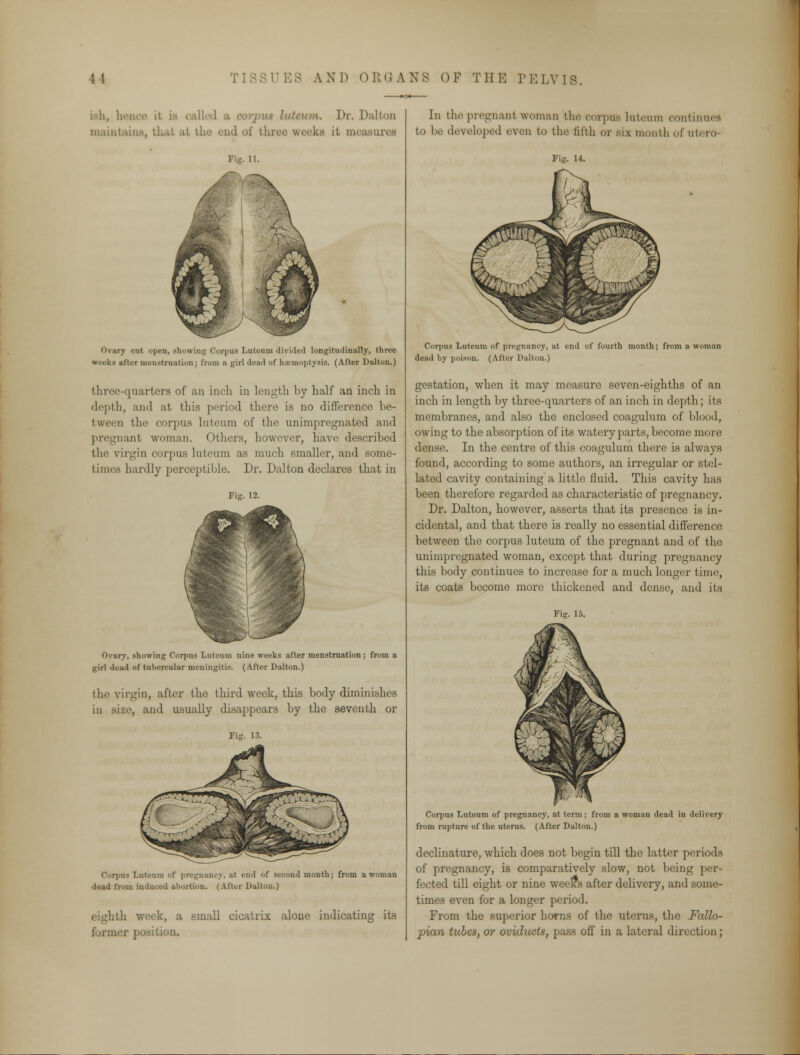 ish, hence it ia called a . Dr. Dalton maintains, that at th ks it measures Fig. 11. Ovary cut open, showing Corpus Luteum divided longitudinallj', throe weeks utter menstruation; from a girl dead of haemoptysis. (After Dalton.) three-quarters of an inch in length by half an inch in depth, and at this period there is no difference be- tween the corpus luteum of the unimpregnated and pregnant woman. Others, however, have described the virgin corpus luteum as much smaller, and some- hardly perceptible. Dr. Dalton declares that in Fig. 12. Ovary, showing Corpus Luteum nine weeks after menstruation; from a girl dead of tubercular meningitis. (After Dalton.) the virgin, after the third week, this body diminishes in size, and usually disappears by the seventh or Fig. 13. Corpus Luteum of pregnancy, at end of second month; from a woman dead from induced abortion. (After Dalton.) eighth week, a small cicatrix alone indicating its former position. In the pregnant woman the corpus luteum continues to be developed even to the fifth or six month of utero- Corpus Luteum of pregnancy, at end of fourth month; from a woman dead by poison. (After Dalton.) gestation, when it may measure seven-eighths of an inch in length by three-quarters of an inch in depth; its membranes, and also the enclosed coagulum of blood, owing to the absorption of its watery parts, become more dense. In the centre of this coagulum there is always found, according to some authors, an irregular or stel- lated cavity containing a little fluid. This cavity has been therefore regarded as characteristic of pregnancy. Dr. Dalton, however, asserts that its presence is in- cidental, and that there is really no essential difference between the corpus luteum of the pregnant and of the unimpregnated woman, except that during pregnancy this body continues to increase for a much longer time, its coats become more thickened and dense, and its Fig. 15. Corpus Luteum of pregnancy, at term; from a woman dead in delivery from rupture of the uterus. (After Dalton.) declinature, which, does not begin till the latter periods of pregnancy, is comparatively slow, not being per- fected till eight or nine weeKS after delivery, and some- times even for a longer period. From the superior horns of the uterus, the Fallo- pian tubes, or oviducts, pass off in a lateral direction ;