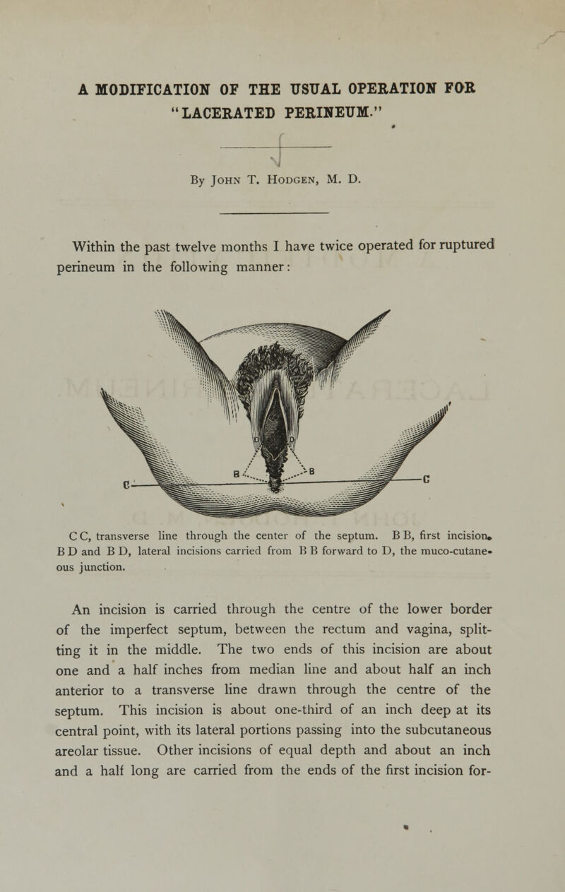 A MODIFICATION OF THE USUAL OPERATION FOR LACERATED PERINEUM. By John T. Hodgen, M. D. Within the past twelve months I have twice operated for ruptured perineum in the following manner: C C, transverse line through the center of the septum. B B, first incision* B D and B D, lateral incisions carried from B B forward to D, the muco-cutane- ous junction. An incision is carried through the centre of the lower border of the imperfect septum, between the rectum and vagina, split- ting it in the middle. The two ends of this incision are about one and a half inches from median line and about half an inch anterior to a transverse line drawn through the centre of the septum. This incision is about one-third of an inch deep at its central point, with its lateral portions passing into the subcutaneous areolar tissue. Other incisions of equal depth and about an inch and a half long are carried from the ends of the first incision for-