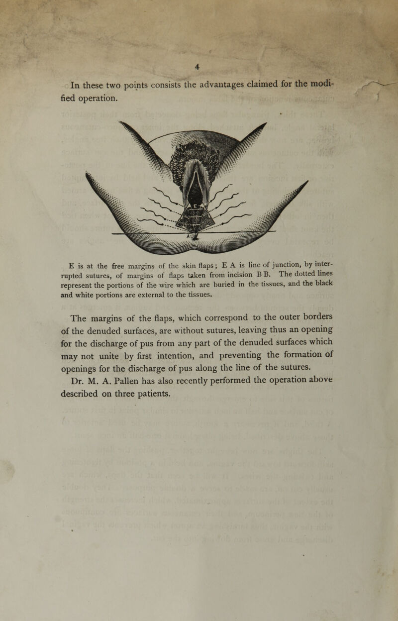 In these two points consists the advantages claimed for the modi- fied operation. E is at the free margins of the skin flaps; E A is line of junction, by inter- rupted sutures, of margins of flaps taken from incision B B. The dotted lines represent the portions of the wire which are buried in the tissues, and the black and white portions are external to the tissues. The margins of the flaps, which correspond to the outer borders of the denuded surfaces, are without sutures, leaving thus an opening for the discharge of pus from any part of the denuded surfaces which may not unite by first intention, and preventing the formation of openings for the discharge of pus along the line of the sutures. Dr. M. A. Pallen has also recently performed the operation above described on three patients.