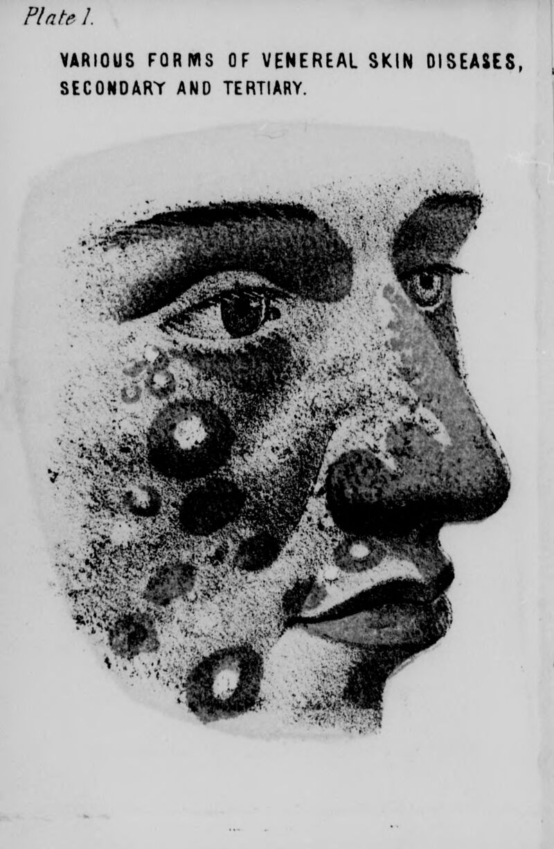 VARIOUS FORMS OF VENEREAL SKIN DISEASES, SECONDARY AND TERTIARY.