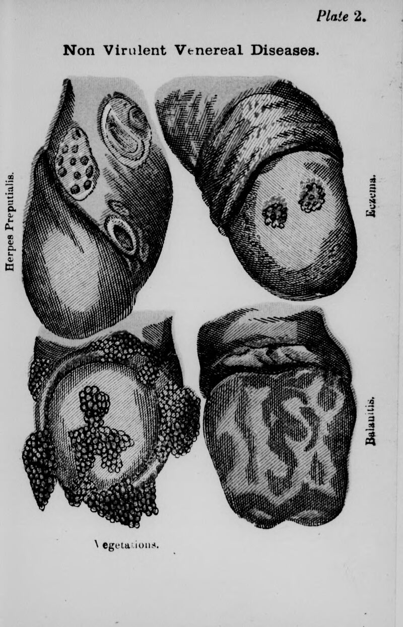 Plate 2. Non Virulent Wnereal Diseases. \ •getatioua.