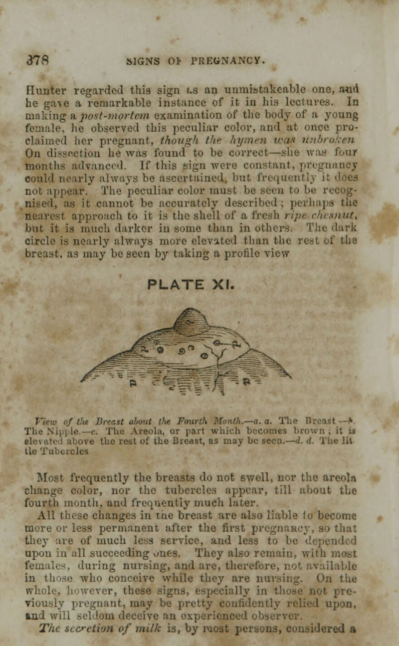 Hunter regarded this sign us an unmistakeablc one, nu<\ he ga\e a remarkable instance of it in his lectures. In making apost-mortem examination of the body of a young female, he observed this peculiar color, and at once pro- claimed her pregnant, though the hymen was unbroJien On dissection he was found to be correct—she wan four months advanced. If this sign were constant, pregnane* could nearly always be ascertained, but frequently it docs not appear. The peculiar color must be sera to be recog- nised, as it cannot be accurately described; perhaps tiie nearest approach to it is the shell of a fresh ripe chesnut, but it is much darker in some than in others. The dark circle is nearly always more elevated than the rest of the breast, as may be seen by taking a profile view PLATE XI. View <f the Jlrer.st about the Fourth Month.—a. a. The Rroast •—* The Nipple.—c. The Areola, or part which becomes brown . it il elevated above the rest of the Breast, as may be seen.—d. d. The lit tie Tubercles Most frequently the breasts do not swell, nor the areola change color, nor the tubercles appear, till about the fourth month, and frequently much later. All these changes in the breast are also liable fo become more or less permanent after the first pregnancy, they are of much less service, and less to ! upon in all succeeding ones. They also remain, with most females, during nursing, and are, therefore, not available in those who conceive while they are nursing. On the whole, however, these signs, especially in those not pre- viously pregnant, may be pretty confidently relied upon, fcnd will seldom deceive an experienced obser The secretion of milk is, by most persons, considered a