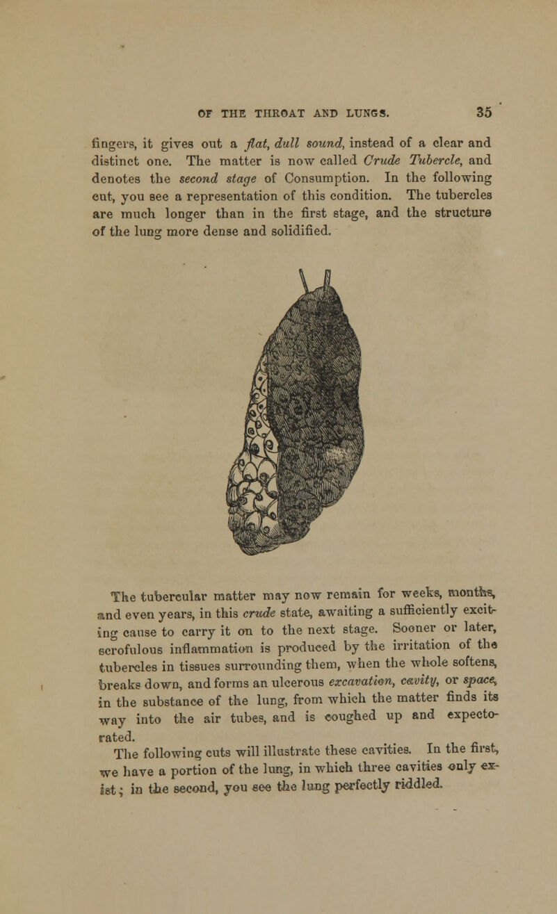 fingers, it gives out a flat, dull sound, instead of a clear and distinct one. The matter is now called Crude Tubercle, and denotes the second stage of Consumption. In the following cut, you see a representation of this condition. The tubercles are much longer than in the first stage, and the structure of the lunar more dense and solidified. The tubercular matter may now remain for weeks, months, and even years, in this crude state, awaiting a sufficiently excit- ing cause to carry it on to the next stage. Sooner or later, ecrofulous inflammation is produced by the irritation of the tubercles in tissues surrounding them, when the whole softens, breaks down, and forms an ulcerous excavation, c&vity, or space, in the substance of the lung, from which the matter finds its way into the air tubes, and is coughed up and expecto- rated. The following cuts will illustrate these cavities. In the first, we have a portion of the lung, in which three cavities only ex- ist; in the second, you see the lung perfectly riddled.