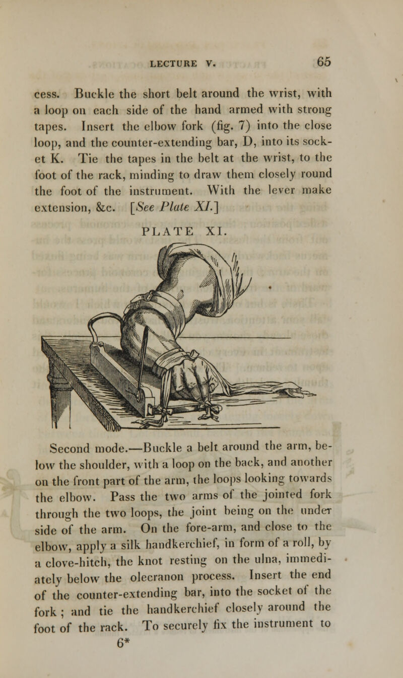 cess. Buckle the short belt around the wrist, with a loop on each side of the hand armed with strong tapes. Insert the elbow fork (fig. 7) into the close loop, and the counter-extending bar, D, into its sock- et K. Tie the tapes in the belt at the wrist, to the foot of the rack, minding to draw them closely round the foot of the instrument. With the lever make extension, &c. [See Plate XI.~\ PLATE XI. Second mode.—Buckle a belt around the arm, be- low the shoulder, with a loop on the back, and another on the front part of the arm, the loops looking towards the elbow. Pass the two arms of the jointed fork through the two loops, the joint being on the under side of the arm. On the fore-arm, and close to the elbow, apply a silk handkerchief, in form of a roll, by a clove-hitch, the knot resting on the ulna, immedi- ately below the olecranon process. Insert the end of the counter-extending bar, into the socket of the fork ; and tie the handkerchief closely around the foot of the rack. To securely fix the instrument to 6*