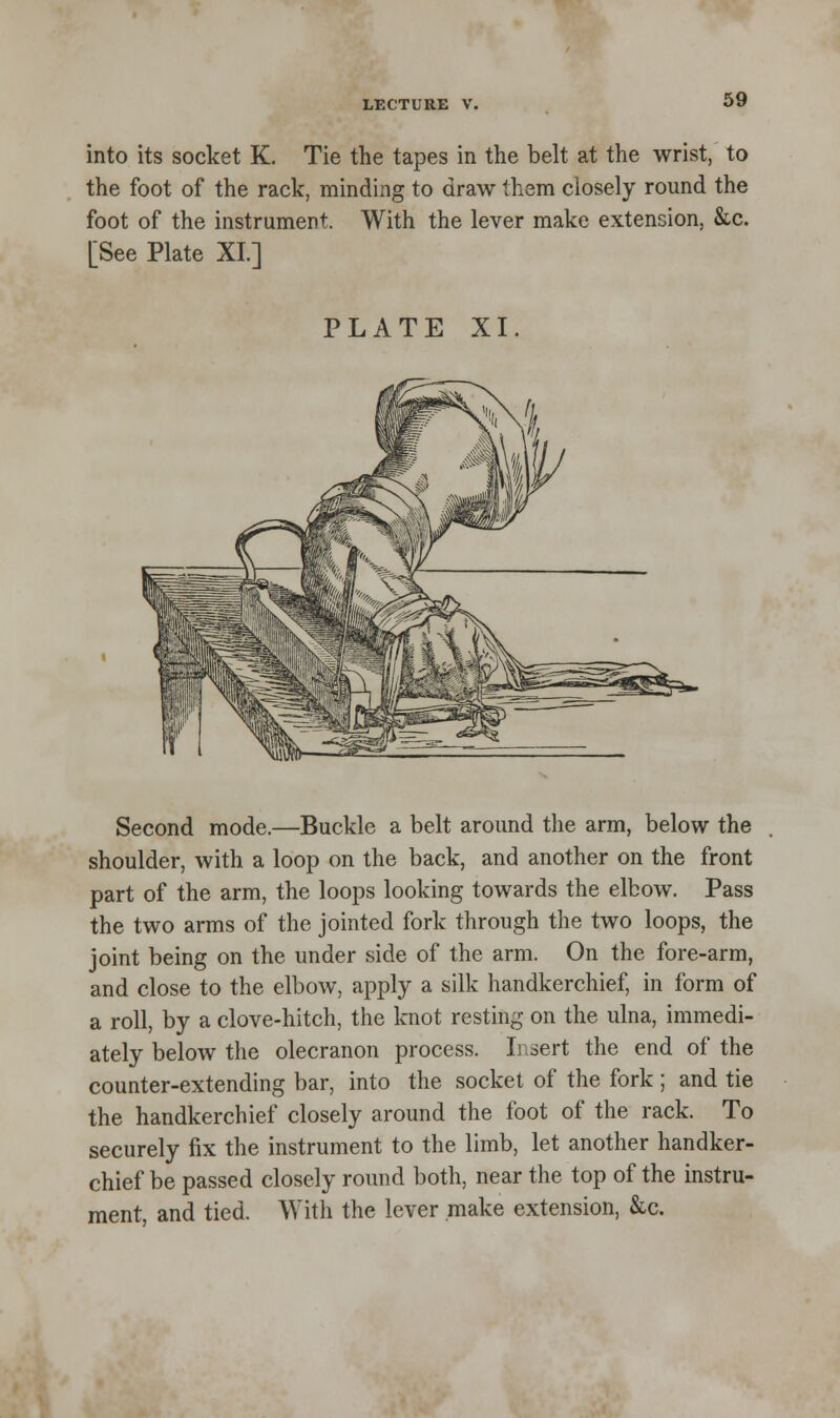 into its socket K. Tie the tapes in the belt at the wrist, to the foot of the rack, minding to draw them closely round the foot of the instrument. With the lever make extension, &c. [See Plate XL] PLATE XI. Second mode.—Buckle a belt around the arm, below the shoulder, with a loop on the back, and another on the front part of the arm, the loops looking towards the elbow. Pass the two arms of the jointed fork through the two loops, the joint being on the under side of the arm. On the fore-arm, and close to the elbow, apply a silk handkerchief, in form of a roll, by a clove-hitch, the knot resting on the ulna, immedi- ately below the olecranon process. Insert the end of the counter-extending bar, into the socket of the fork ; and tie the handkerchief closely around the foot of the rack. To securely fix the instrument to the limb, let another handker- chief be passed closely round both, near the top of the instru- ment, and tied. With the lever make extension, &c.