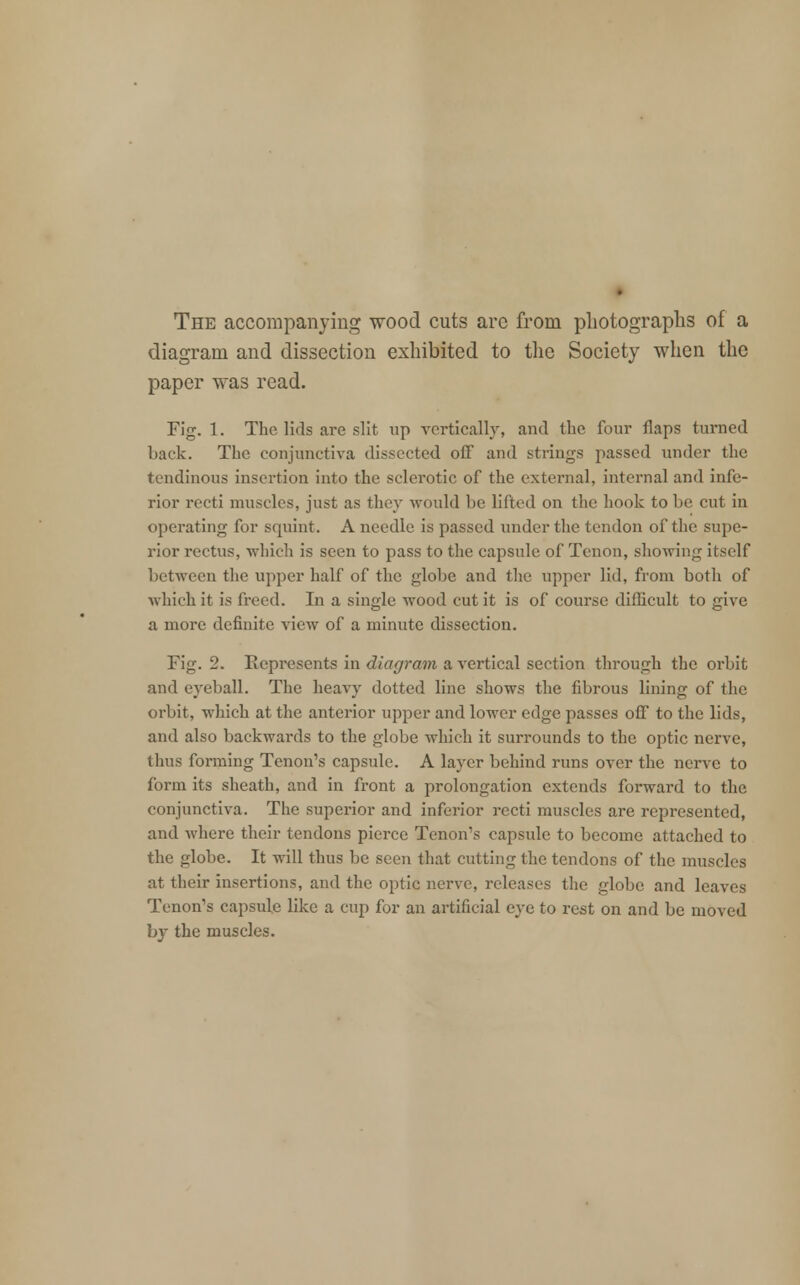 The accompanying wood cuts arc from photographs of a diagram and dissection exhibited to the Society when the paper was read. Fig. 1. The lids are silt up vertically, and the four flaps turned back. The conjunctiva dissected off and strings passed under the tendinous insertion into the sclerotic of the external, internal and infe- rior recti muscles, just as they would be lifted on the hook to be cut in operating for squint. A needle is passed under the tendon of the supe- rior rectus, -which is seen to pass to the capsule of Tenon, showing itself between the upper half of the globe and the upper lid, from both of which it is freed. In a single wood cut it is of course difficult to give a more definite view of a minute dissection. Fig. 2. Represents in diagram a vertical section through the orbit and eyeball. The heavy dotted line shows the fibrous lining of the orbit, which at the anterior upper and lower edge passes off to the lids, and also backwards to the globe which it surrounds to the optic nerve, thus forming Tenon's capside. A layer behind runs over the nerve to form its sheath, and in front a prolongation extends forward to the conjunctiva. The superior and inferior recti muscles are represented, and where their tendons pierce Tenon's capsule to become attached to the globe. It will thus be scon that cutting the tendons of the muscles at their insertions, and the optic nerve, releases the globe and leaves Tenon's capsule like a cup for an artificial eye to rest on and be moved by the muscles.